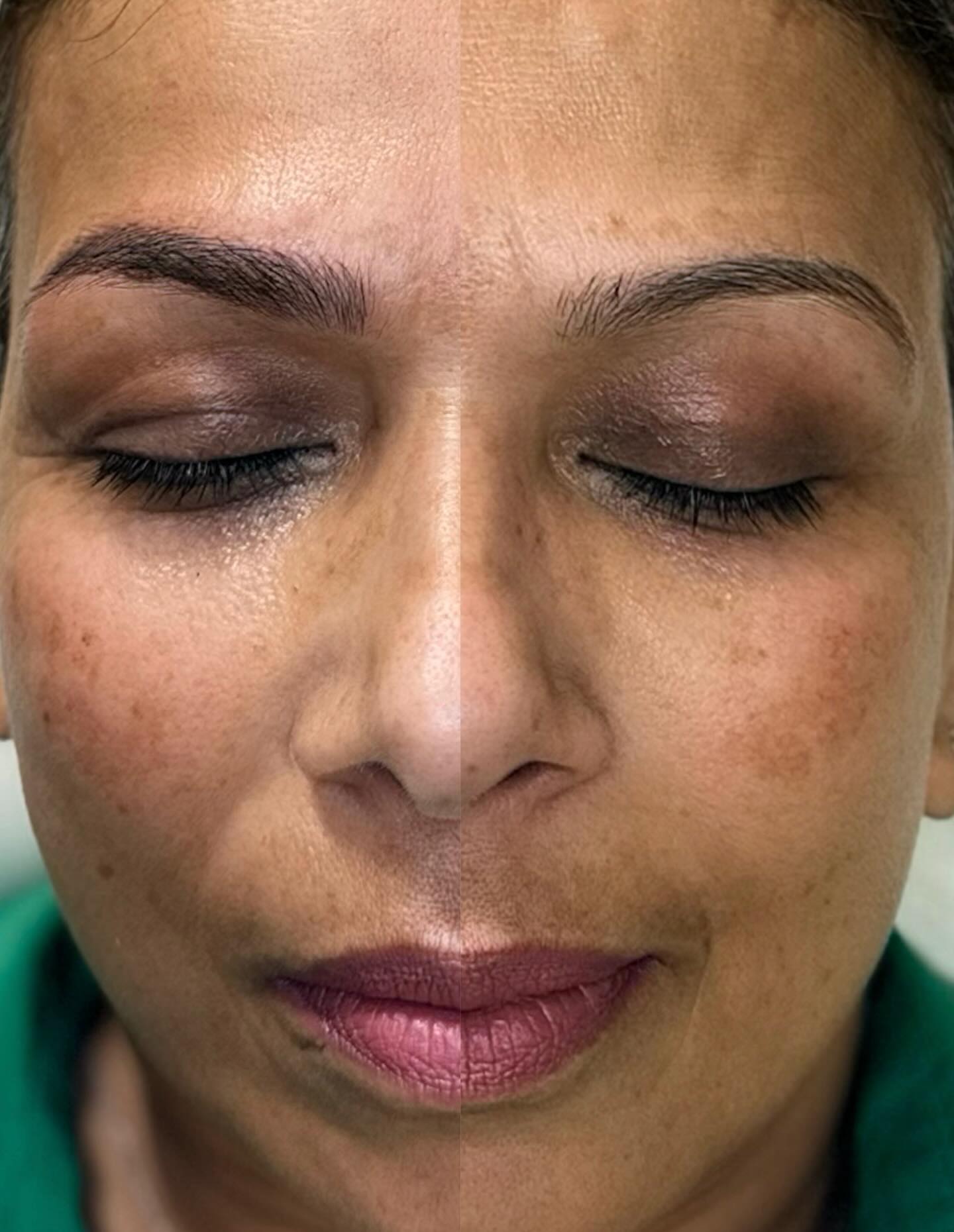 School drop-offs. Meetings. Practice. Repeat.
When was the last time you did something for you?
Microblading at Arch Envy Eyebrow gives busy women effortless, beautiful brows that are ready when you are — even on zero-makeup days.
✔ Wake up ready
✔ Save time every morning
✔ Feel confident without trying
You don’t need more on your to-do list.
You need something that makes life easier.
💖 Book your brow transformation today
🔗 in bio to reserve your appointment
📲 813-215-0052
💻 www.archenvyeyebrow.com
📍6601 Memorial Hwy, Suite 116, TPA
#brows #tampa #permanentmakeup #microbladingeyebrows #microbladingtampa