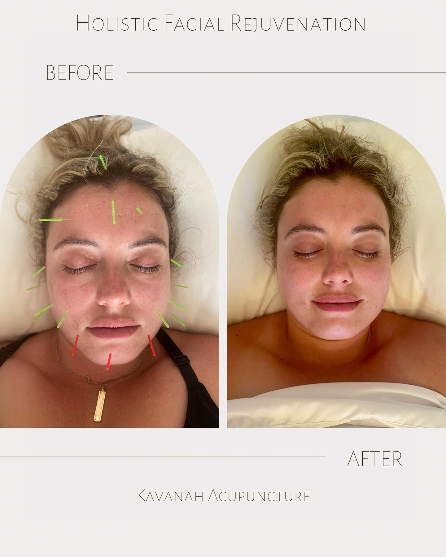 *During ➡️ After
Facial tension release
De-puff (lymphatic drainage)
Even skin tone
Calm the spirit ✨
#acupuncture #cosmeticacupuncture #facialrejuvenation #mindbodymedicine #healthonpurpose #wellness #womenshealth #greenbeauty #יופיטבעי
#beautyfromwithin #naturalbeauty #beautytreatment #guasha #cupping #lymphaticdrainage #דיקור #דיקורקוסמטי #בריאות #בריאותבכוונה #דיקורסיני #טיפולקוסמטי