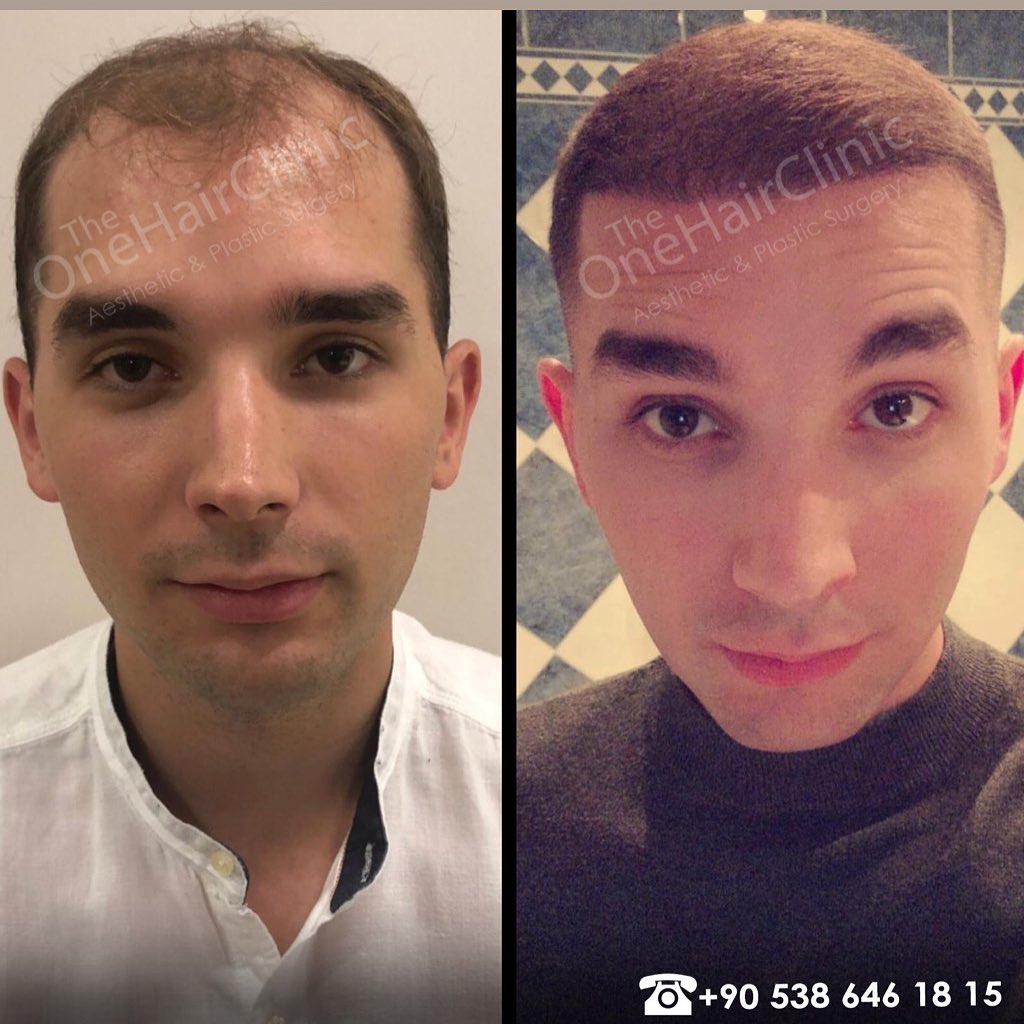 #hairline #haartransplantationtürkei #haartransplantation #theonehairclinicandplasticsurgery #prp #stamzellenbehandlung #mezoterapi #naturelline #maximalgrafts #beforeafter #