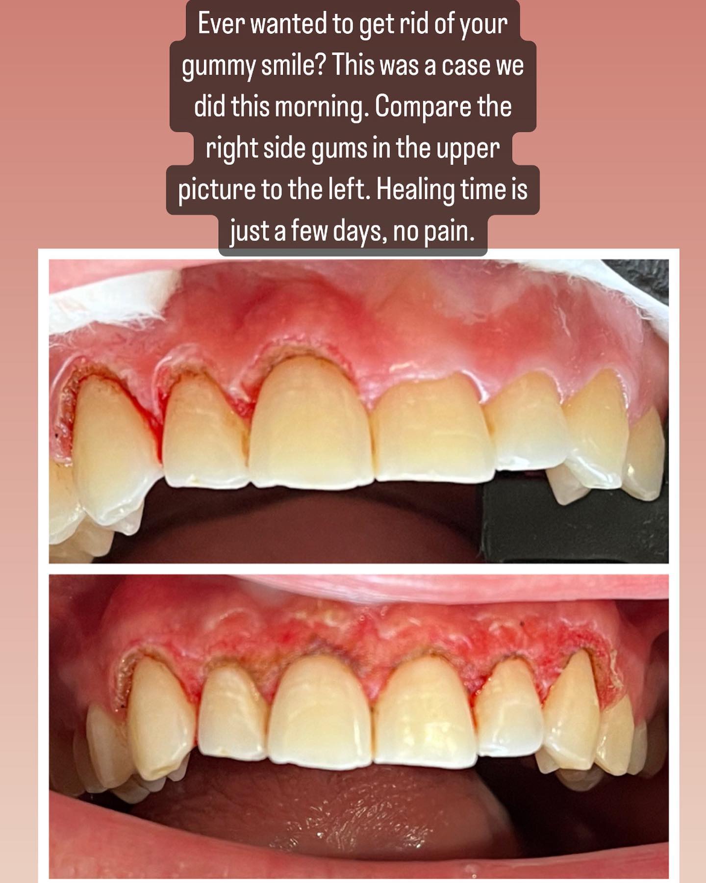 Ever wanted to get rid of your gummy, smile? Laser gingivectomy! Quick, painless and super easy. Appointment time under an hour and results are instant but even more beautiful in a week. Will post again once patients gums heal. Call our office to book yours 😉