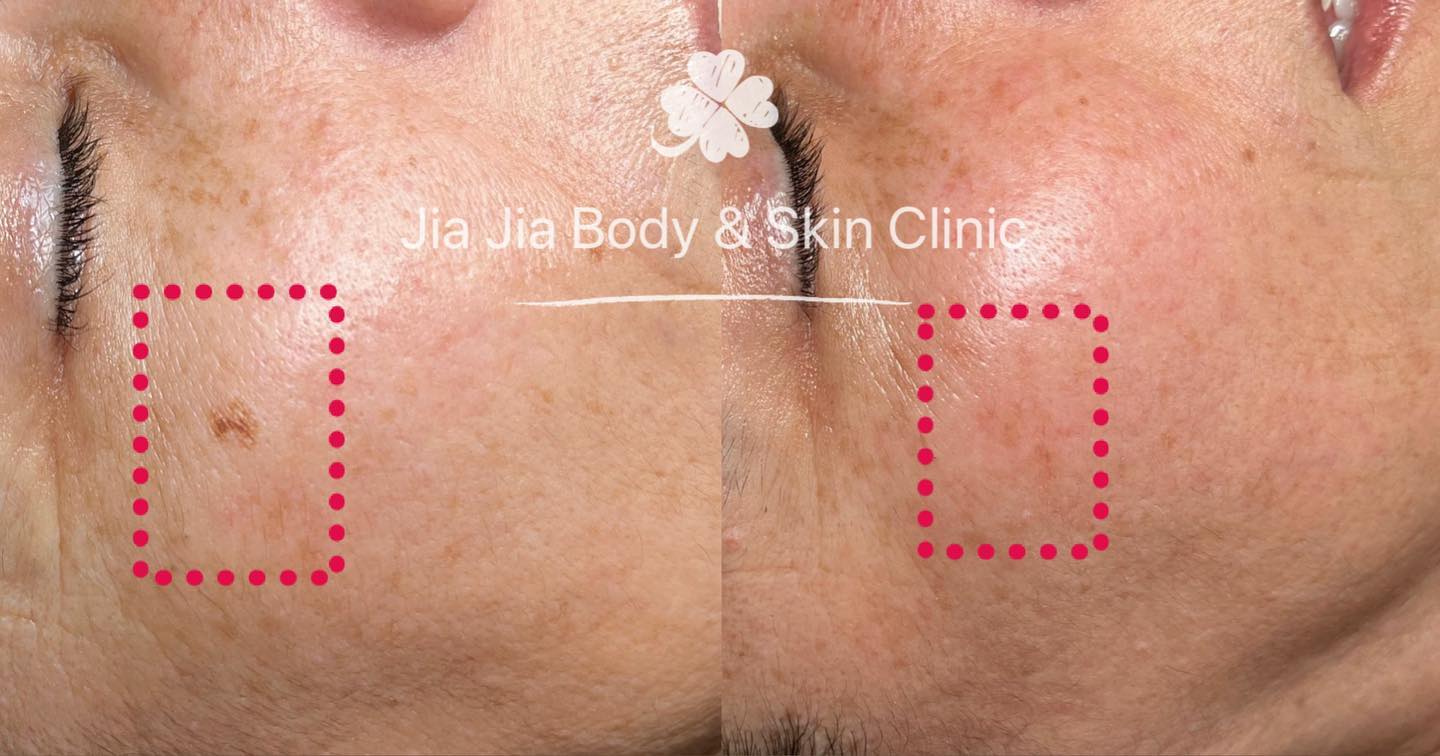 Two months after the treatment
#pigmentationremoval
#ipl
#clearskin
#jiajiabodyandskinclinic