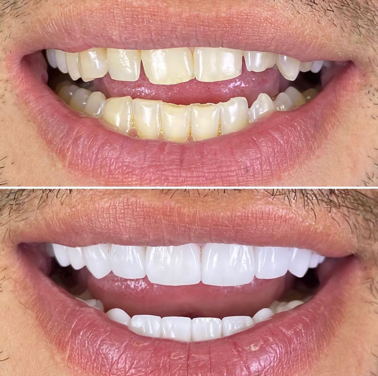 20 EMAX Veneer Before/After of one of our many patient from all over the world.
-
https://www.veneers.istanbul
-
WhatsApp: 00905330164562
-
#veneers #smiledesign #cosmeticdentistry #restorativedentistry #emax #veneer #laminates #zirconia #zirconium #hollywoodsmile #dentalcrowns #crowns #veneersistanbul #porcelainveneers #emaxveneers