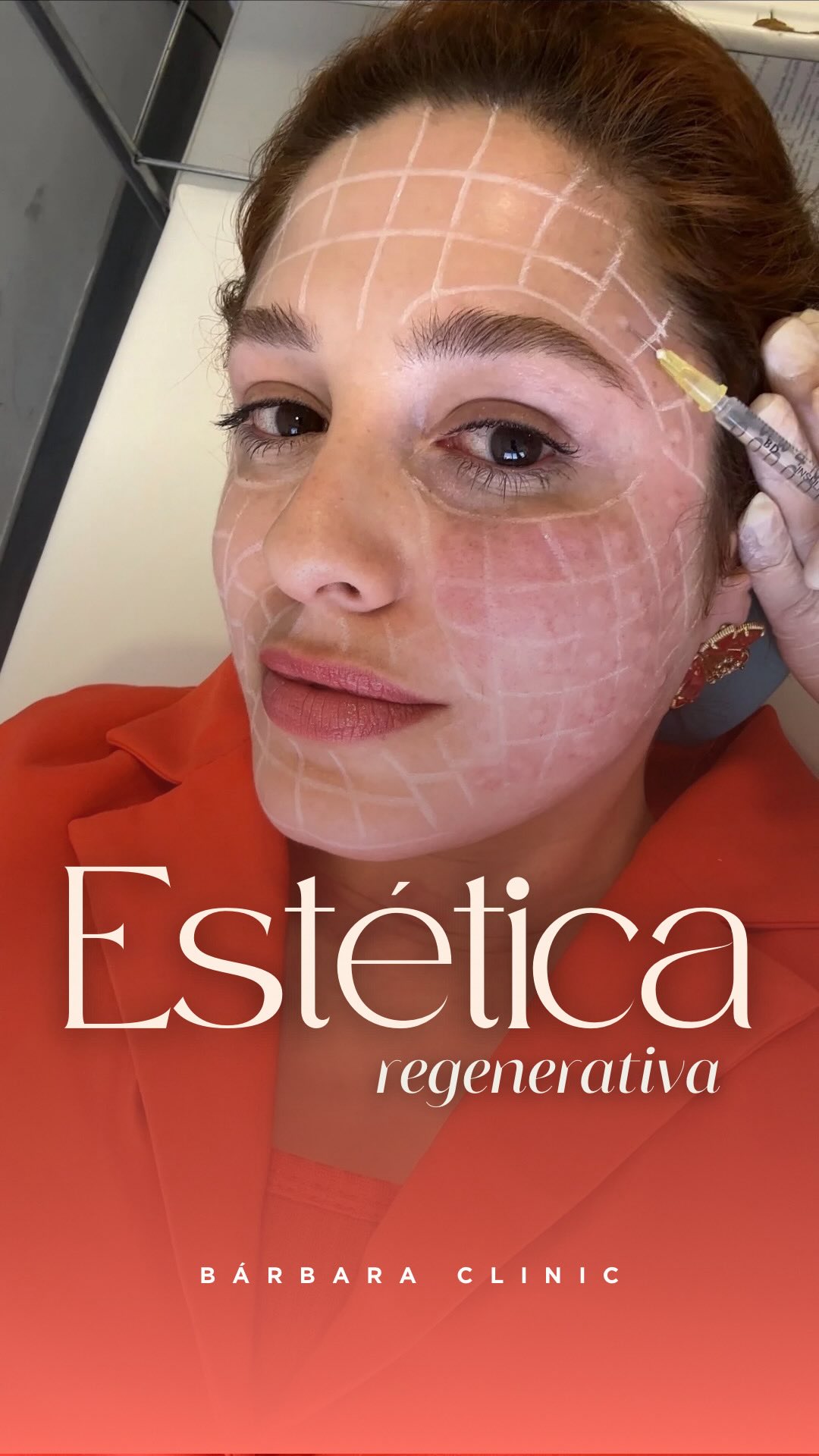 Estética regenerativa não é sobre voltar no tempo. É sobre cuidar do tecido que existe hoje.
Fortalecer a pele.
Estimular os cabelos e sobrancelhas.
Melhorar textura, viço, densidade e resposta biológica.
Trata-se de devolver qualidade, função e equilíbrio.
Quando o cuidado é bem conduzido, o organismo responde.
Com estímulo correto. 💉
Com tempo. ⏳
Com ciência. 🧬
Pele e couro cabeludo seguem o mesmo princípio: regenerar é respeitar o processo, não forçar um resultado.
Estética regenerativa também não é sobre desacelerar o tempo. É cuidar do agora para que o futuro seja mais saudável e belo!
#estéticaregenerativa #esteticaregenerativa #skinbooster #tricologia #tricologiaregenerativa #uberabamg #esteticauberaba