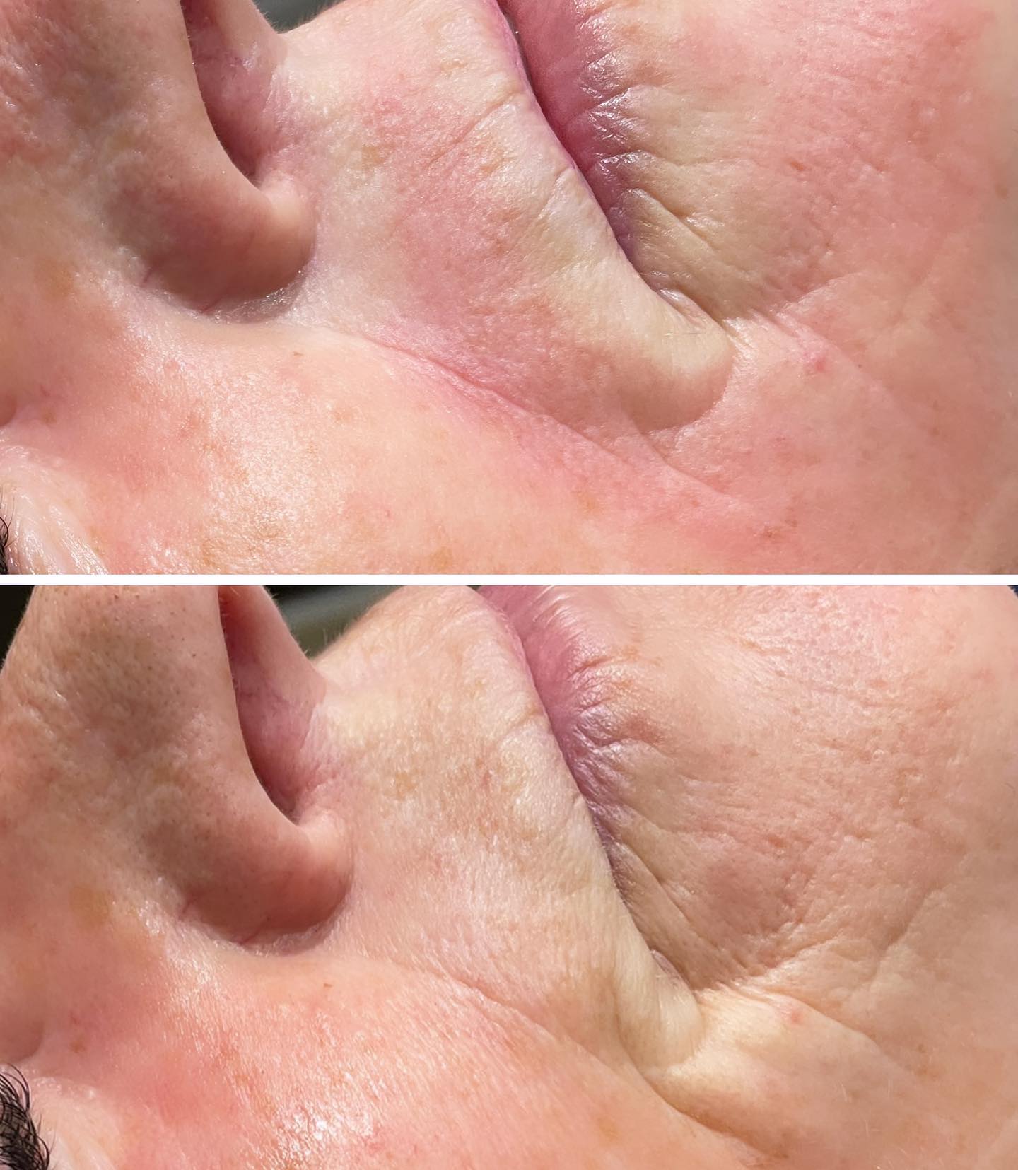 After just one treatment we can already see an improvement in fine lines around the mouth and enlarge pores.
We have used
-ultra-sonic peeling and micro needling #microneedling#cacipeel#skinspecialist#beautiquebarlborough