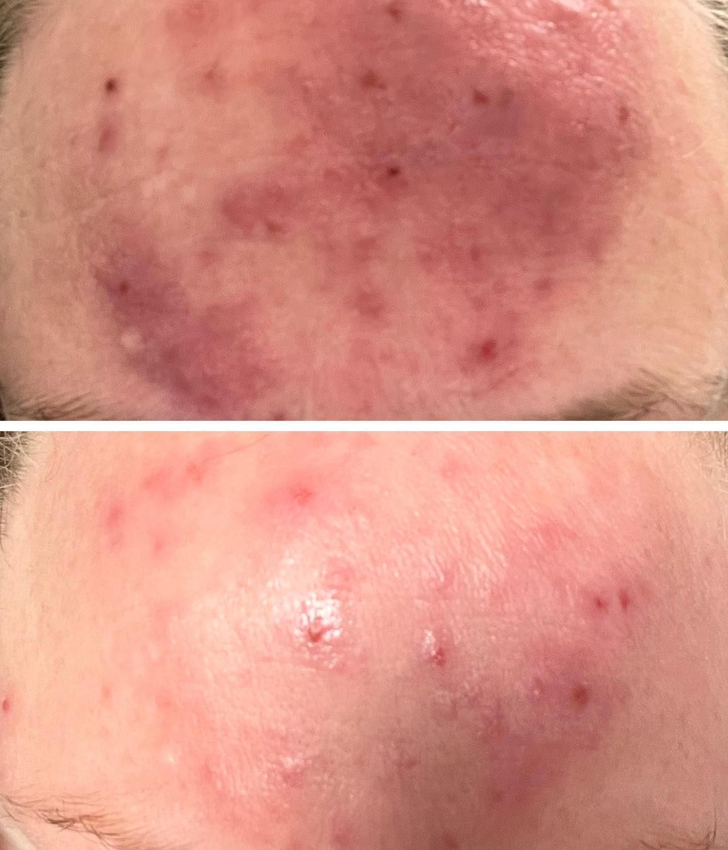 3 weeks apart using @dermaluxled Dermalux is clinically proven and certified in the treatment of a wide range of medical and cosmetic skin conditions, delivering unique targeted combinations of Blue 415nm, Red 633nm and Near Infrared 830nm wavelengths to promote skin health and rejuvenation, accelerate healing and resolve problem skin conditions for the face and body #dermaluxled#clearskin#chesterfield#barlborough