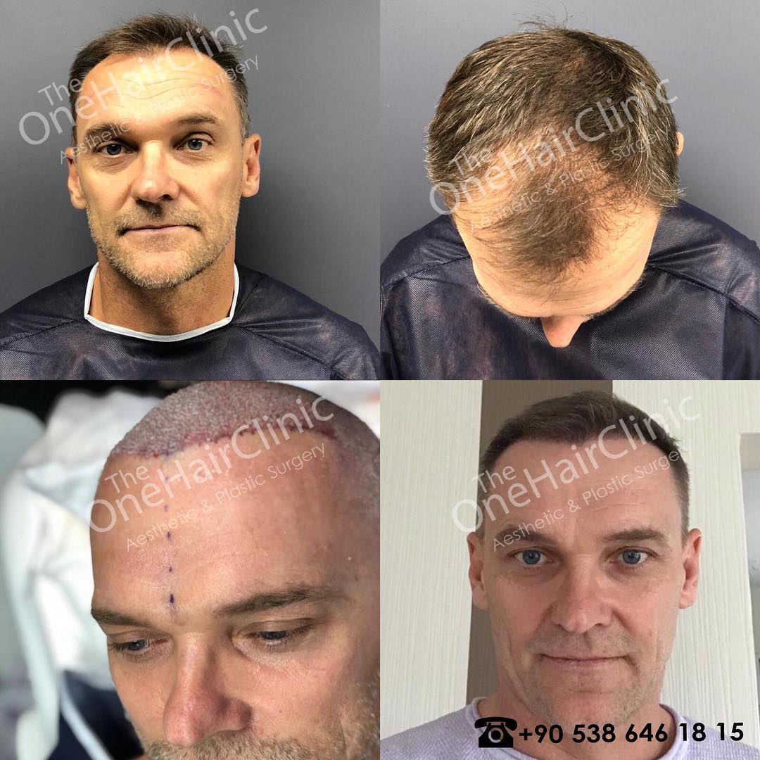 #hairtransplant #haartransplantation #naturel #hairline #fuetechnique #prptreatment #theonehairclinicandplasticsurgery #avusturya🇦🇹 #österreich🇦🇹 #switzerland🇨🇭 #germany🇩🇪 #turkey🇹🇷 #saçekimiistanbul #saçekimi #fue #istanbul #