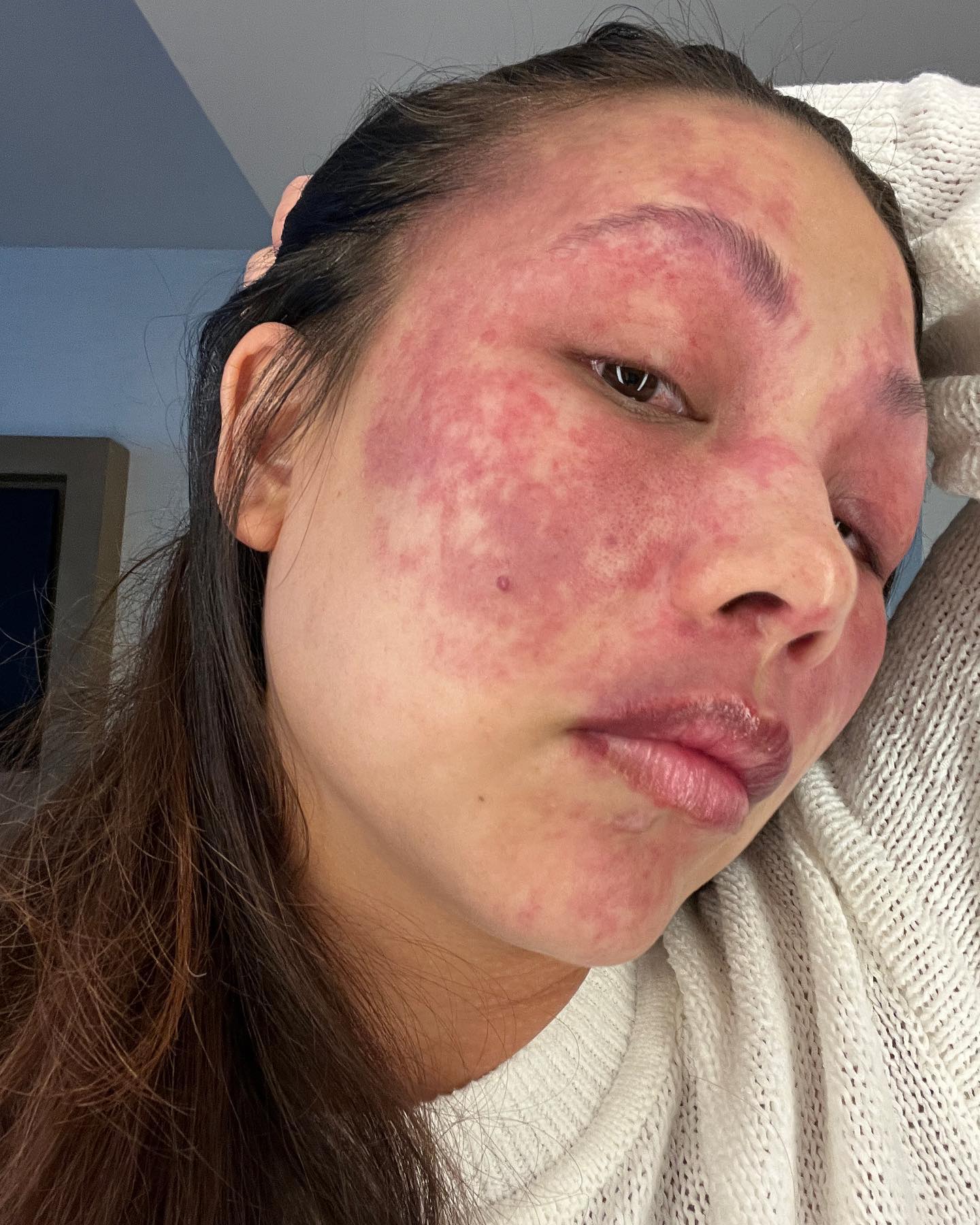 This past week I did a pulse due laser treatment at Beckmann Laser Institute. I want to share my journey and experience with you all and answer any questions you may have.