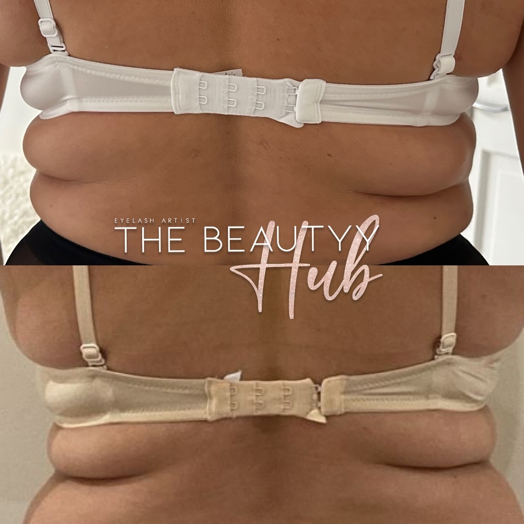 Results just after a week from Lemon bottle fat dissolving on the bra bulge area🍋
Incredible results with just a single session, the area has reduced down majorly in size!
Above picture - before the session
Bottom picture - a week after the session
Amount of sessions : 1
Amount of bottles used : 4
@lemonbottle
Book you’re session now on: www.Thebeautyyhub.com
All information and price list is provided on our website the link is on our bio or you can also send us a direct message for further assistance/ information 🍋