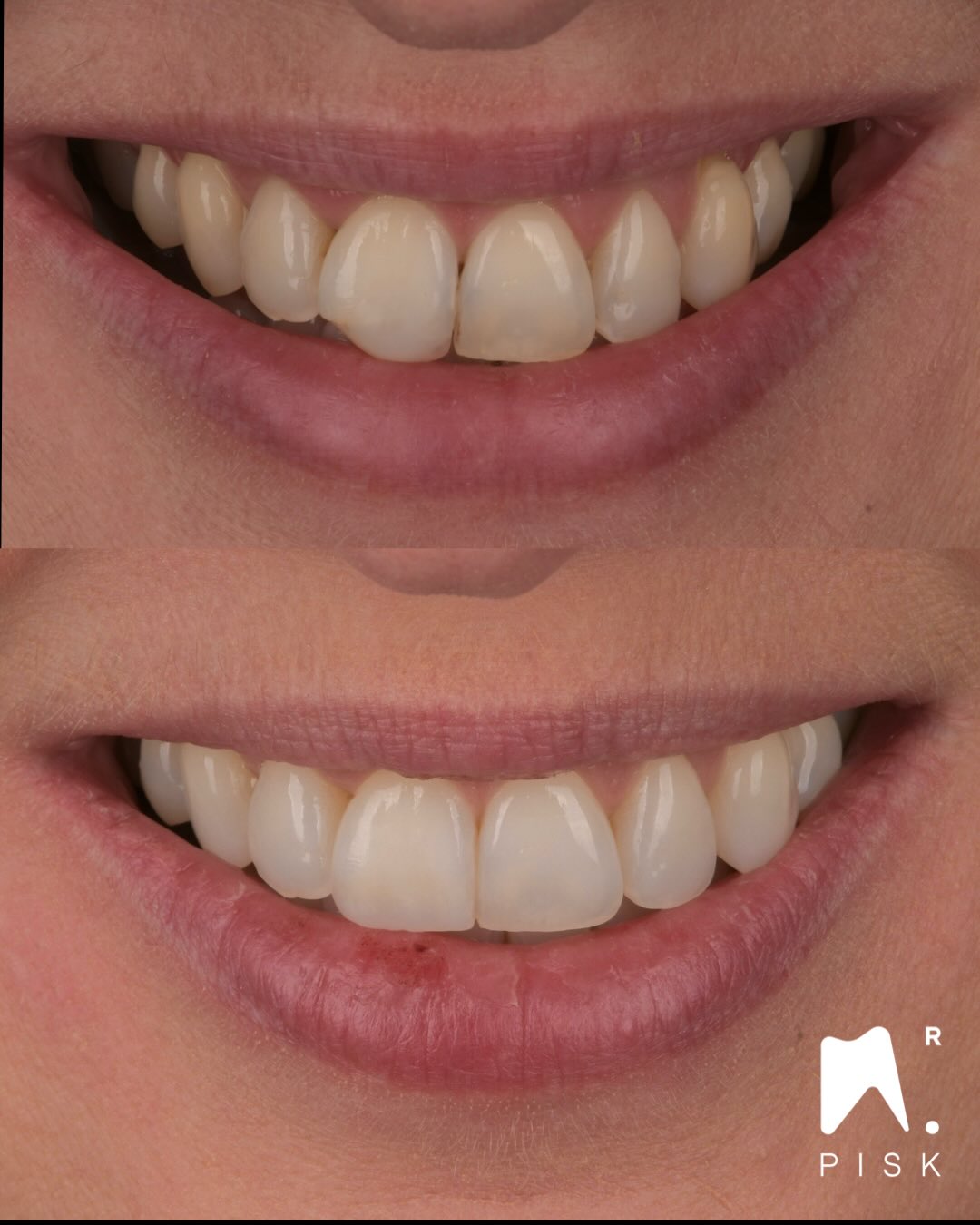 Layering & injection : book your course ! DM
🇫🇷 Français
Dans ce cas clinique, nous avons d’abord réalisé un traitement orthodontique afin d’aligner et de corriger l’axe des dents.
Un éclaircissement dentaire a ensuite été effectué afin d’améliorer la couleur.
Une fracture très basse en palatin était présente : la première étape a donc consisté à remonter la marge palatine, avant la réalisation du mur palatin.
Enfin, la dent antérieure numéro 11 a été restaurée avec une technique de stratification et d’injection de composite, pour un résultat naturel et conservateur.
⸻
🇬🇧 English
In this clinical case, orthodontic treatment was first carried out to align the teeth and correct their angulation.
Tooth whitening was then performed to improve the color.
A very deep palatal fracture was present, so the first step was to relocate the palatal margin before building the palatal wall.
Finally, the anterior tooth #11 was restored using a layering and injectable composite technique for a natural and conservative result.