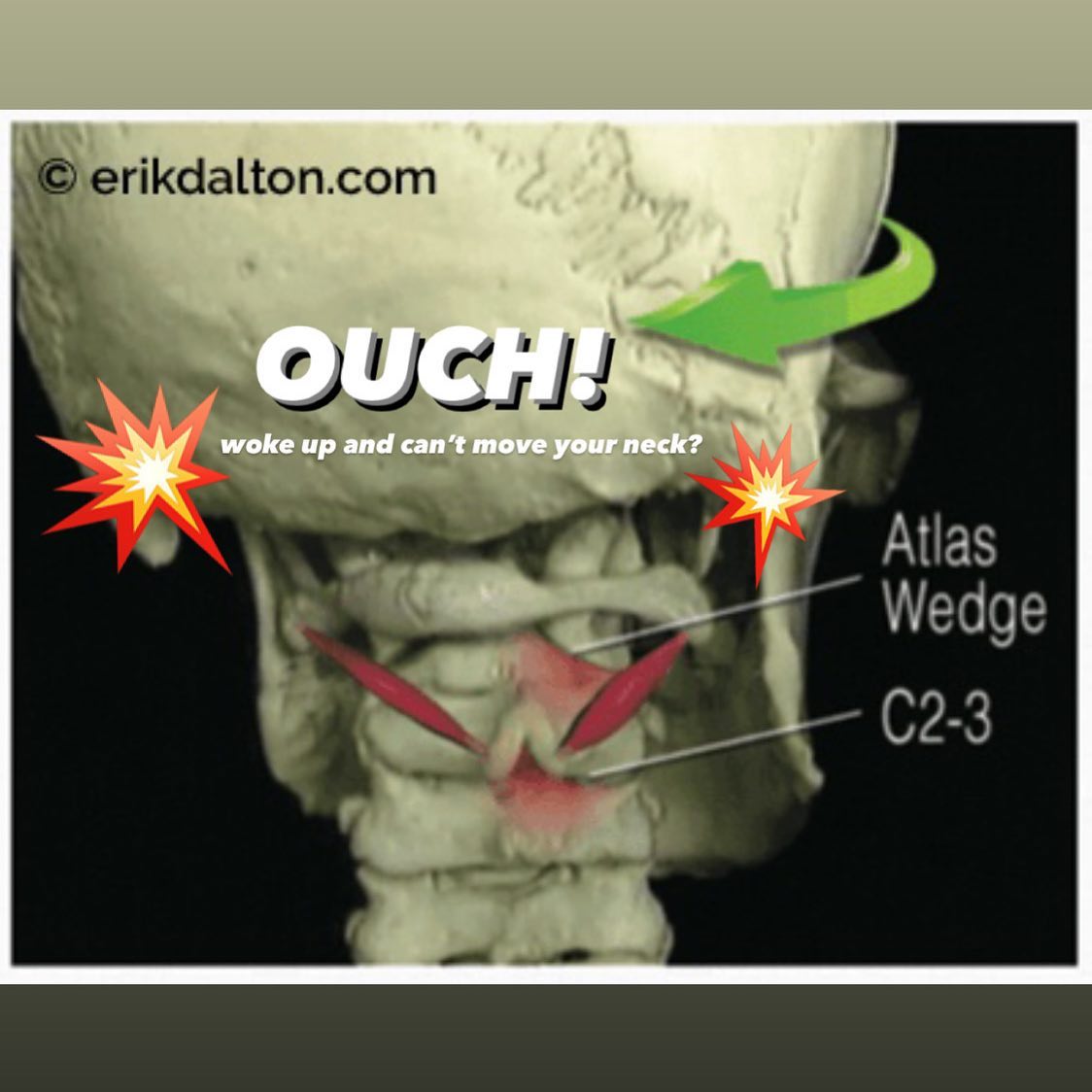 Ever wake up with that 💥OUCH💥 in the neck and find you’re stuck looking at the world sideways for a couple days? 🙃
You might be suffering from ‘Stomach-Sleeper’s Headache’!
Sleeping with a rotation to the neck can create mechanoreceptive and nociceptive bombardment from overstretched spinal ligaments, joint capsules, and suboccipital muscles, which may wreak havoc enough to convince the brain to protectively guard or elicit pain. ⚡️⚡️
If rotation is prolonged, an overstretched obliquues capitis inferior muscle of the suboccipital group on one side and it’s locked up twin on the other can cause chronic spasm that fixates C1 on C2. If the head is forced to rotate, the joint jamming moves down the chain to C2–3.
Since the dura (the outermost membrane of our brain and spinal cord) 🧠 firmly attaches to only three spinal segments - the foramaen magnum, C2–3, and the sacrum - the brain does not take kindly to bony disturbances at this key neurological center. 😵💫
As the nervous system directs all bodily functions, treating mechano-sensitivity in neural structures via gentle skin manipulation, fascial stretch, and mobilizations for bones attaching to the dura mater can provide that much-sought after relief! 😮💨
#headaches #neckpain #neckstiffness #necktension #wokeupwrong #sleptfunny #fascia #duramatter #nervoussystem #themoreyouknow #manualosteopathictherapy #craniosacraltherapy #integrativetherapy #radicalwellness #radicalwellnessyk
- - -
Dalton, E. (n.d.). Stomach-Sleeper’s Headache. Retrieved from https://erikdalton.com/blog/stomach-sleepers-headache/
