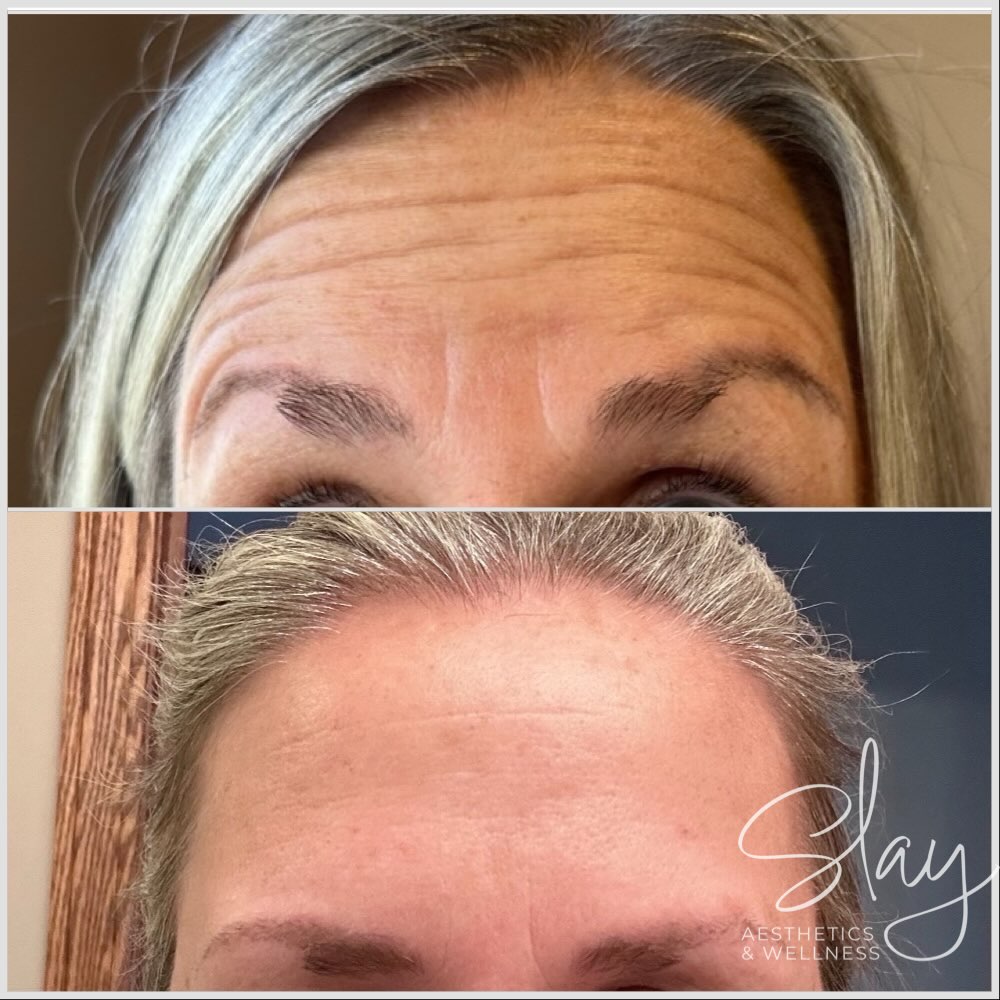 Love a good forehead glow-up 🙌✨
Smooth, refreshed, and still completely YOU. Strategic wrinkle relaxer in the upper face can soften those horizontal lines and frown lines while keeping natural movement. Subtle changes = big confidence. 💉💛
Ready for your own refresh? Message me or book through the link in bio.
#NewarkOhioBotox
#HeathOhioBotox
#GranvilleOhioAesthetics
#OhioBotox
#CentralOhioAesthetics
LickingCountyAesthetics
NewarkOhioAesthetics
HeathOhioAesthetics
GranvilleOhioBotox
AestheticInjector
NurseInjector
InjectorNurse
AdvancedInjector
MedicalAestheticsOhio
BotoxNearMe
OhioMedSpa
WrinkleRelaxer
ForeheadLines
FrownLinesTreatment
NaturalBotoxResults
SubtleEnhancements
FreshNotFrozen
ConfidenceInYourSkin
AgingGracefully
PreventativeBotox
SmoothForehead
WomenOwnedBusinessOhio
SupportLocalOhio
BookYourBotox
SlayAesthetics