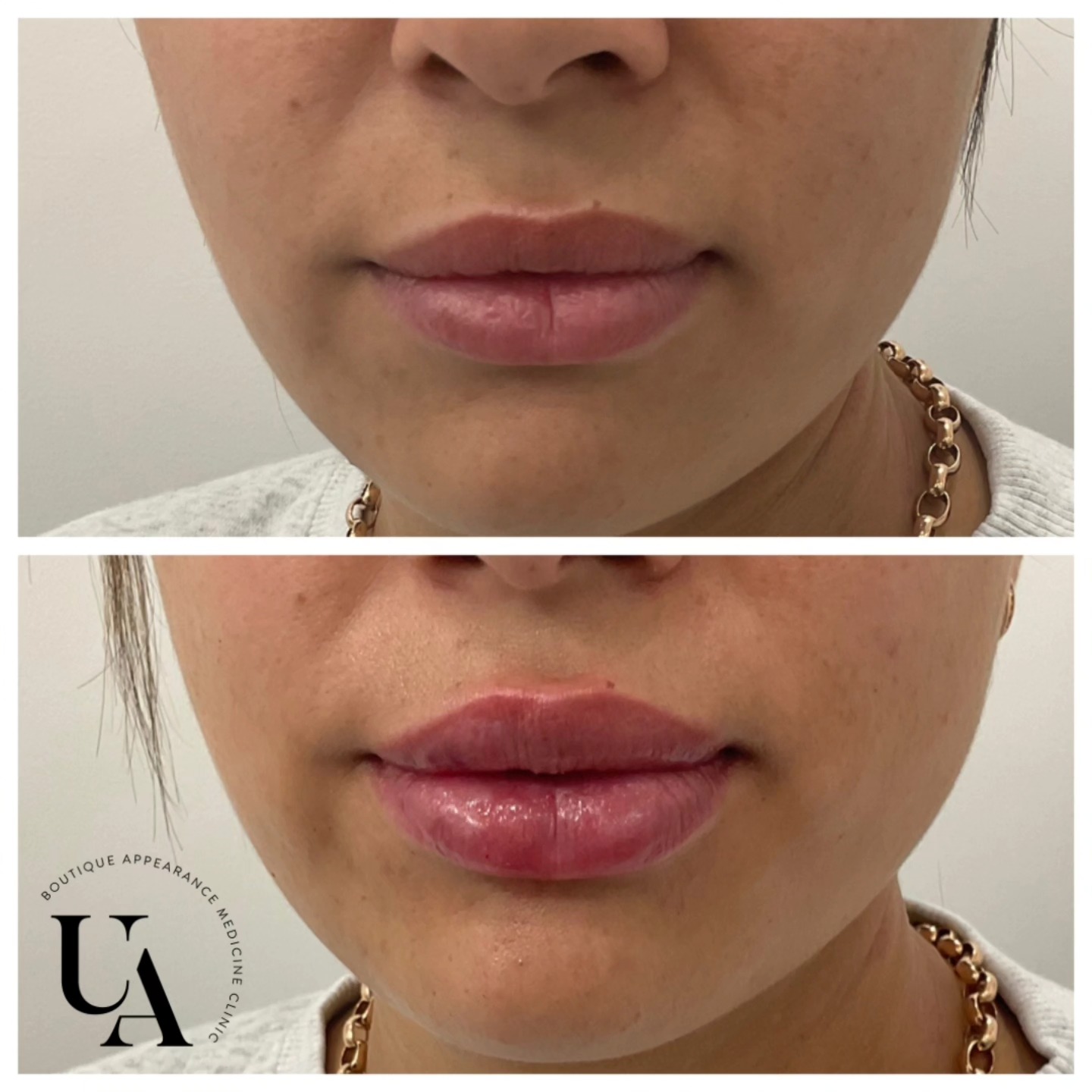 It might be raining today, but I'm in my happy place, catching up with lovely people❤️
Hope everyone's day is going well too x
#lippies #kapiticoast #lipfillerkapiti
Dermal filler injections are Medical devices for the treatment of loss of volume in the skin. Dermal fillers have risks and benefits. Ask your doctor if dermal filler injections are is right for you. For further information ask your doctor or go to www.medsafe.govt.nz