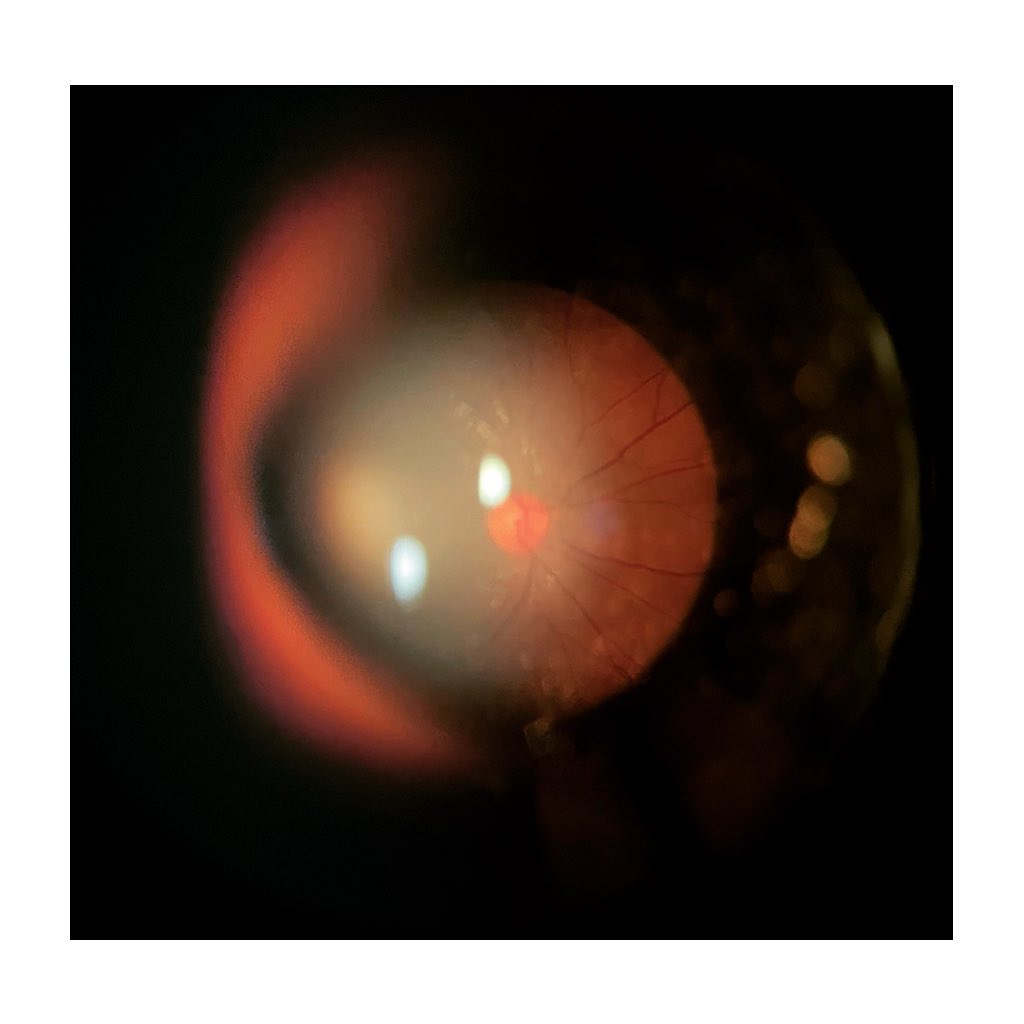 B L I N D S P O T 👁 Ne confiez pas votre vue à n’importe qui #wearevisionspecialists #weareoptometrists #readingdifficulties #examendevie 😁#visionforlife #reichertvrx #optometriste #strasbourg #opticien #derhy #myopiacontrol #lesopticienseyelike