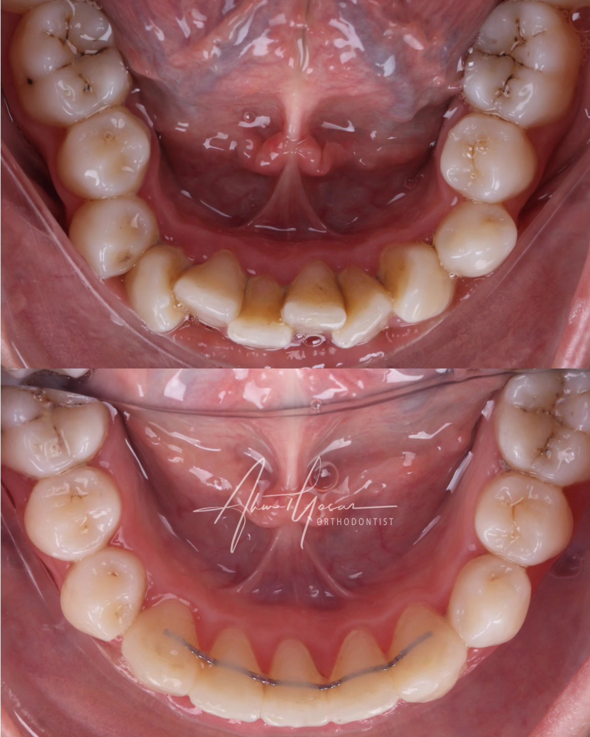 Şeffaf plak / Aligners.
Lower inciser extraction.
.
#bursaortodonti #şeffafplak #dişteli #çenebozukluğu #drahmetyasar
1. fotoğrafın tarihi: 10.12.2022
2. fotoğrafın tarihi: 07.10.2024
-Paylaşımlar bilgilendirme amaçlıdır; tanıtım ve reklam niteliği taşımaz.
-Paylaşılan görüntüler, tedavisini gerçekleştirdiğimiz hastamızın açık rızası alınarak yayımlanmıştır.
-Paylaşım yönetmelik gereği yoruma kapatılmıştır.
-Her cerrahi veya girişimsel işlemde sonuçlar kişiden kişiye değişiklik gösterebilir. İşlem öncesinde hekiminizden detaylı görüş almanız önerilir.
-Bu içerik, 12.11.2025 tarihli Resmî Gazete'de yayımlanan SagIık Hizmetlerinde Tanıtım ve Bilgilendirme Faaliyetleri Hakkında Yönetmelik'in 7. maddesine uygun olarak hazırlanmıştır.