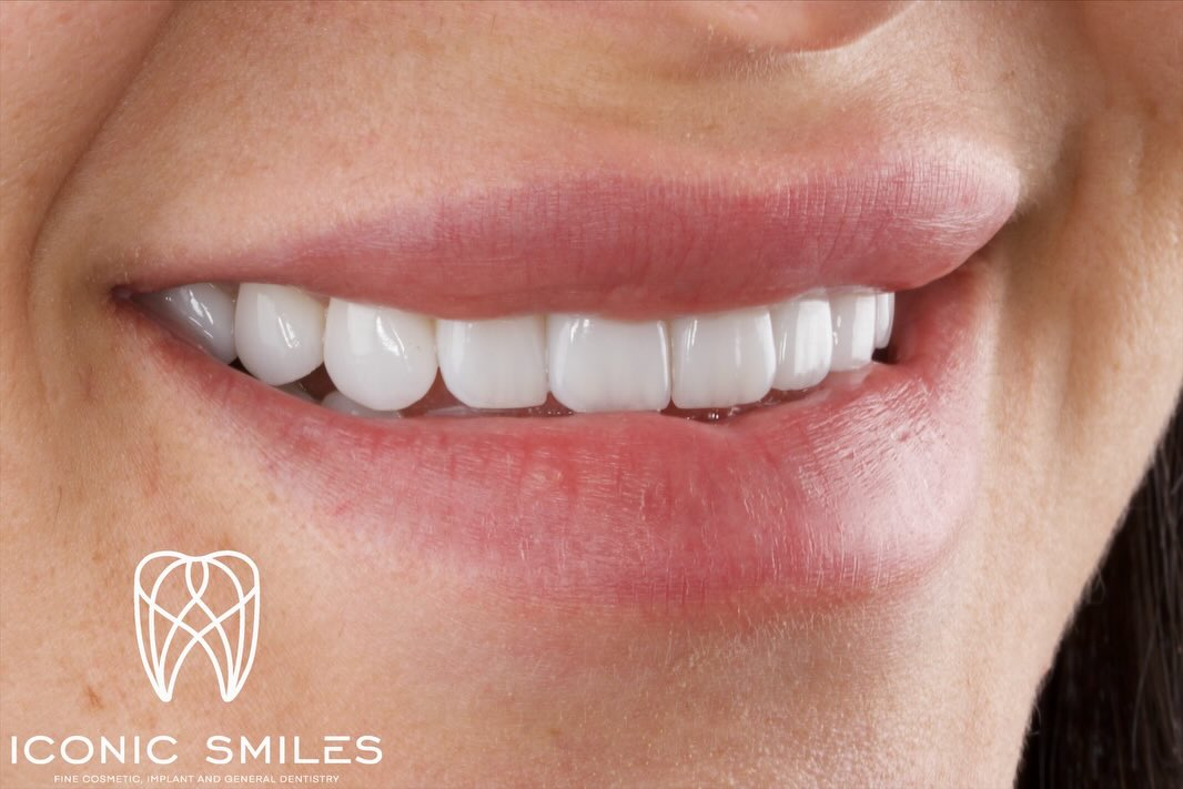 🌟Porcelain Veneers 🌟
Porcelain veneers are not all the same! We have added natural details to the veneers and a glass like finish to the veneers to finish with this rejuvenating smile.
DISCLAIMER
All information provided by Dr Matthew El Azzi - DEN0001996783, Registered Dentist, is for general and educational purposes only. It does not constitute medical advice and should not be relied upon as a substitute for professional consultation.
Images and videos are of real patients who have given consent. No filters, AI enhancements, or unrealistic lighting are used. These materials are intended to demonstrate examples of treatment but do not guarantee results. Individual results, risks, potential complications, and recovery times vary between patients.
Patient stories are individual experiences and should not be interpreted as indicative of expected outcomes for all patients. Your experience may differ.
Before commencing any treatment, you should seek independent advice from a qualified, AHPRA-registered health practitioner and consider obtaining a second opinion.
For details about each specific treatment, head to:
https://www.iconicsmiles.com.au
Dr Matthew El Azzi - DEN0001996783
Registered Dentist, General Registration