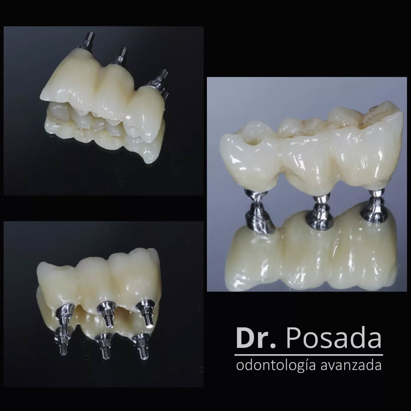 Remplazar dientes 🦷que se han perdido hace muchos años implica tener en cuenta mucho factores; en este caso en particular optamos por hacer #coronas atornilladas sobre #implantes dentales 🔩 que se colocaron de manera guiada por odenador y elegimos como material la #cubiczirconia monolítica de quinta generacion para lograr un equilibrio entre resistencia y similitud a los tejidos naturales, traslucidez y estética #perfecta 🔝
☎️601 755 20 46 #bogota
📲 +57 3046529022 #🇨🇴
.
.
.
.
.
.
.
.
.
.
.
.
.
.
.
.
.
.
.
.
.
.
.
.
.
.
.
.
.
.
.
.
.
.
.
.
.
.
#coronadental #esteticadental #calidad #zirconiadental #tecnologiadental #laboratoriodental #diseñodigital #newsmile #dentalphotography #prosthodontics #implantes #dentallife #coronasobreimplante #implantesdentales