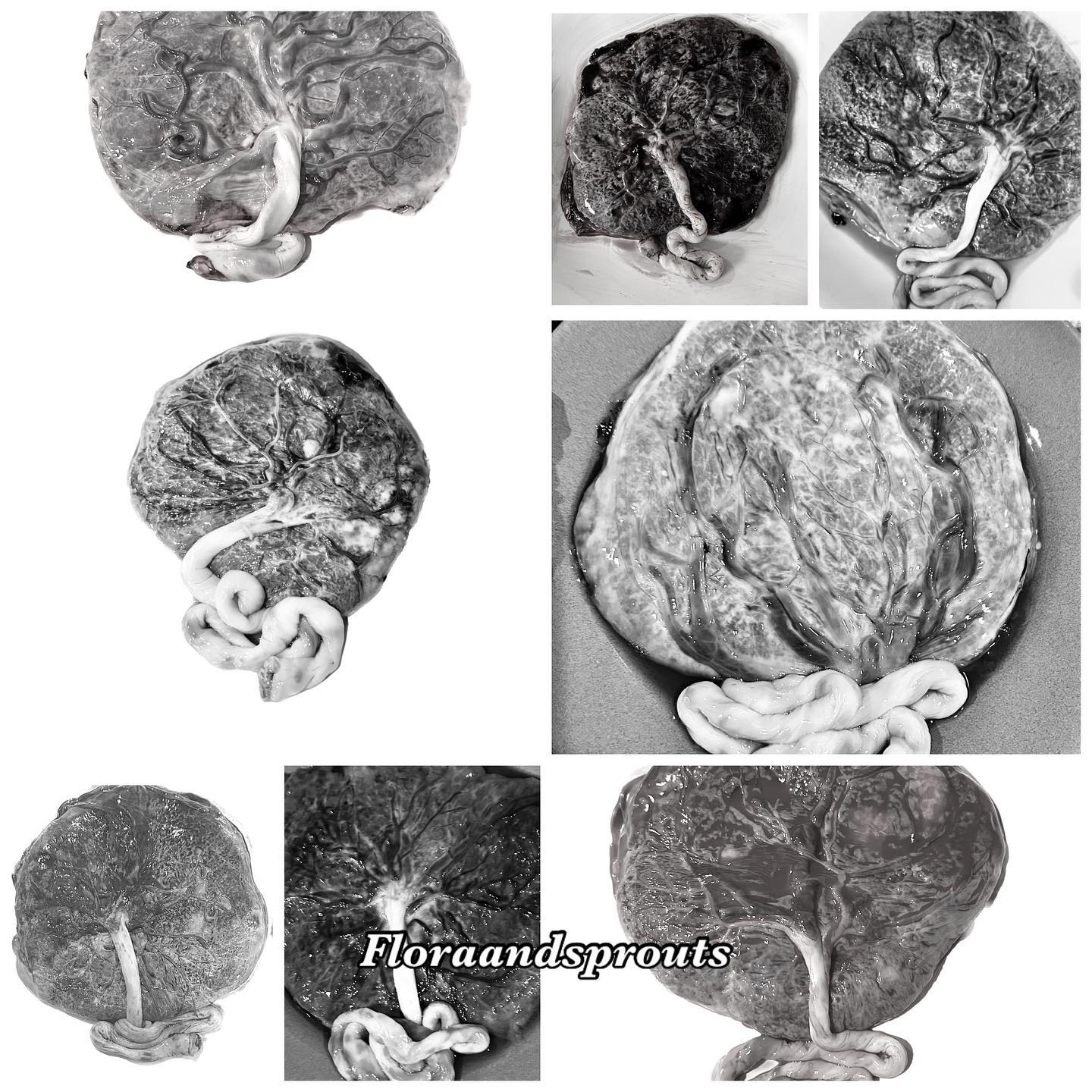 Love seeing so many people taking advantage of the benefits of placenta pills.
I feel like every placenta has a story and every placenta is as different as a fingerprint.
They are your baby’s tree of life in the womb!
#placenta #placentaencapsulation #treeoflife