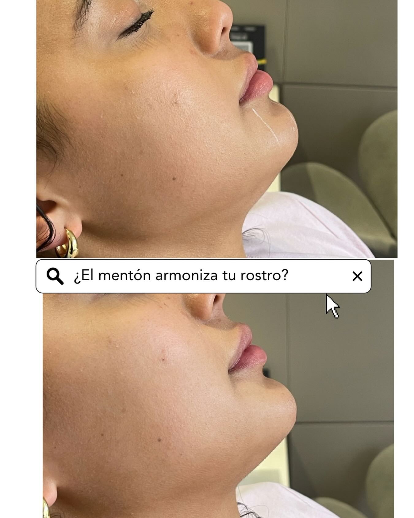 No tienes la cara redonda.
A veces no es la forma del rostro, es la falta de proyección del mentón lo que cambia por completo cómo se percibe la cara.
Cuando el mentón no acompaña, el rostro puede verse más corto, más ancho o menos definido… y no porque esté mal, sino porque la armonía no está completa.
La estética no es cambiar rasgos, es entender proporciones