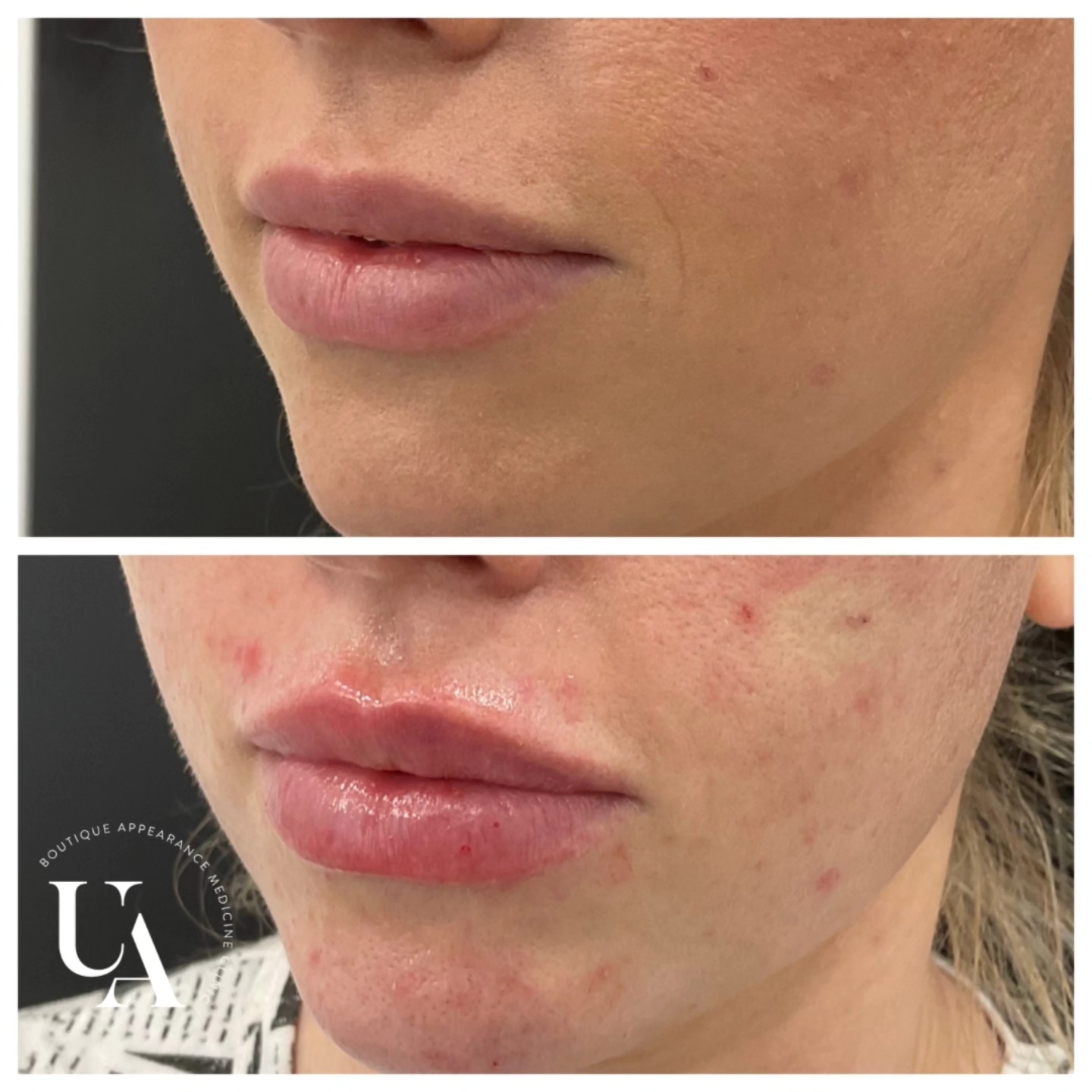 Hello lovelies! Apologies if I have been slower than I normally am at replying to messages, I promise I will respond as soon as I can. As I am a one man band, I have to prioritise tasks and my priority is always the person infront of me❤️
Also how gorgeous are these lippies!? 😍😍
#lipsbyrachel #lipskapiti #dermalfillers #kapiticosmeticclinic #uniqueaesthetics
Dermal filler injections are Medical devices for the treatment of loss of volume in the skin. Dermal fillers have risks and benefits. Ask your doctor if dermal filler injections are is right for you. For further information ask your doctor or go to www.medsafe.govt.nz