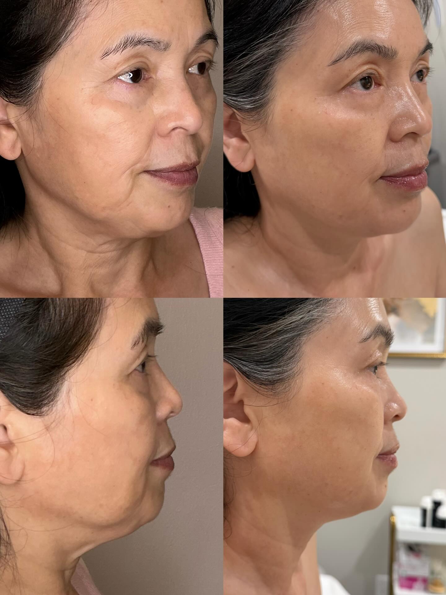 Ultherapy Prime + Neck @radiesse
Radiesse is a regenerative biostimulator, not just a filler - which is the best part about it as it improves skin quality💫
4 months later👇🏻
Subtle lift.
Refined contour.
Naturally elegant aging.
#ultherapyprime #fillerinjection #antiwrinkle #antiaging
