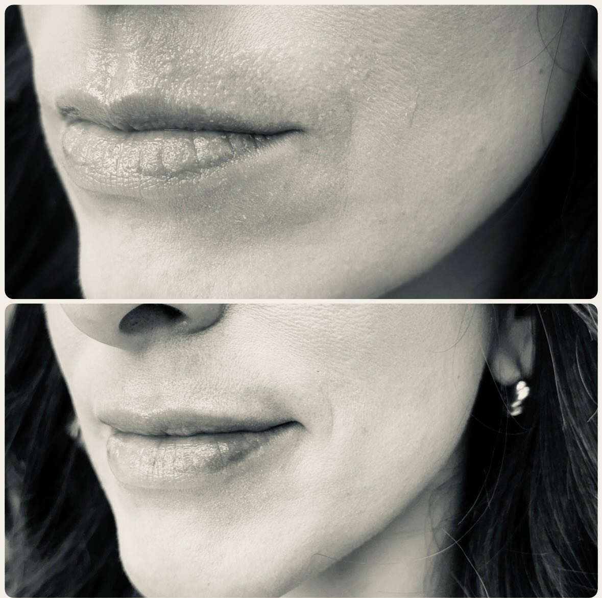 0.5 syringe of Volbella 💋
One of my favorites for smoothing those tiny lip crinkles and restoring hydrated, youthful volume.
.
#cloudnineclinic #juvederm #restylane #botox #botoxcosmetic botoxhighlandsranch dysport