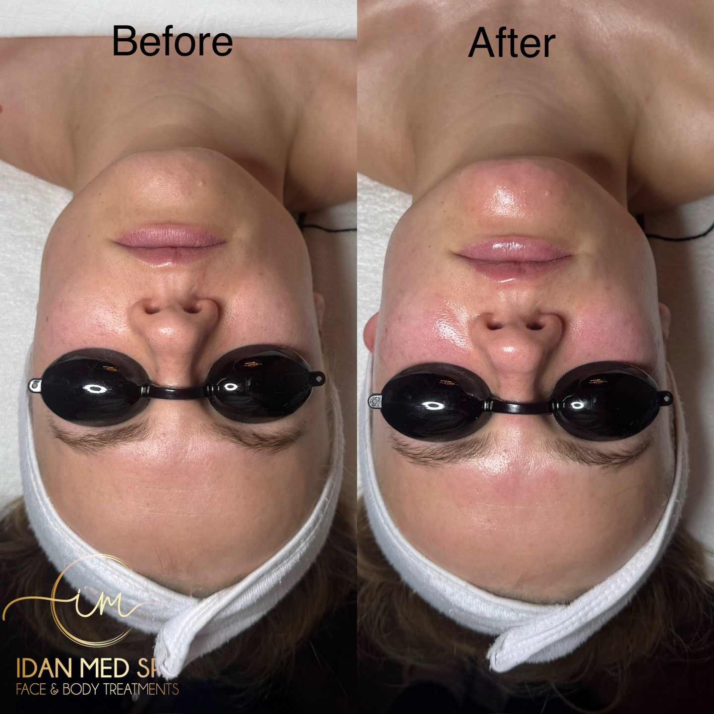 Glass skin doesn’t lie
Real results. Real glow.
Our Glass Skin Facial deeply cleans, hydrates, and leaves your skin smooth and radiant.
Before ➡️ After
📍 SF & Encino
#GlassSkin #GlassSkinFacial #FacialGlow #BeforeAndAfter #RealResults SkinGoals HealthySkin GlowingSkin LuxuryFacial MedSpa IdanMedSpa SFMedSpa EncinoMedSpa