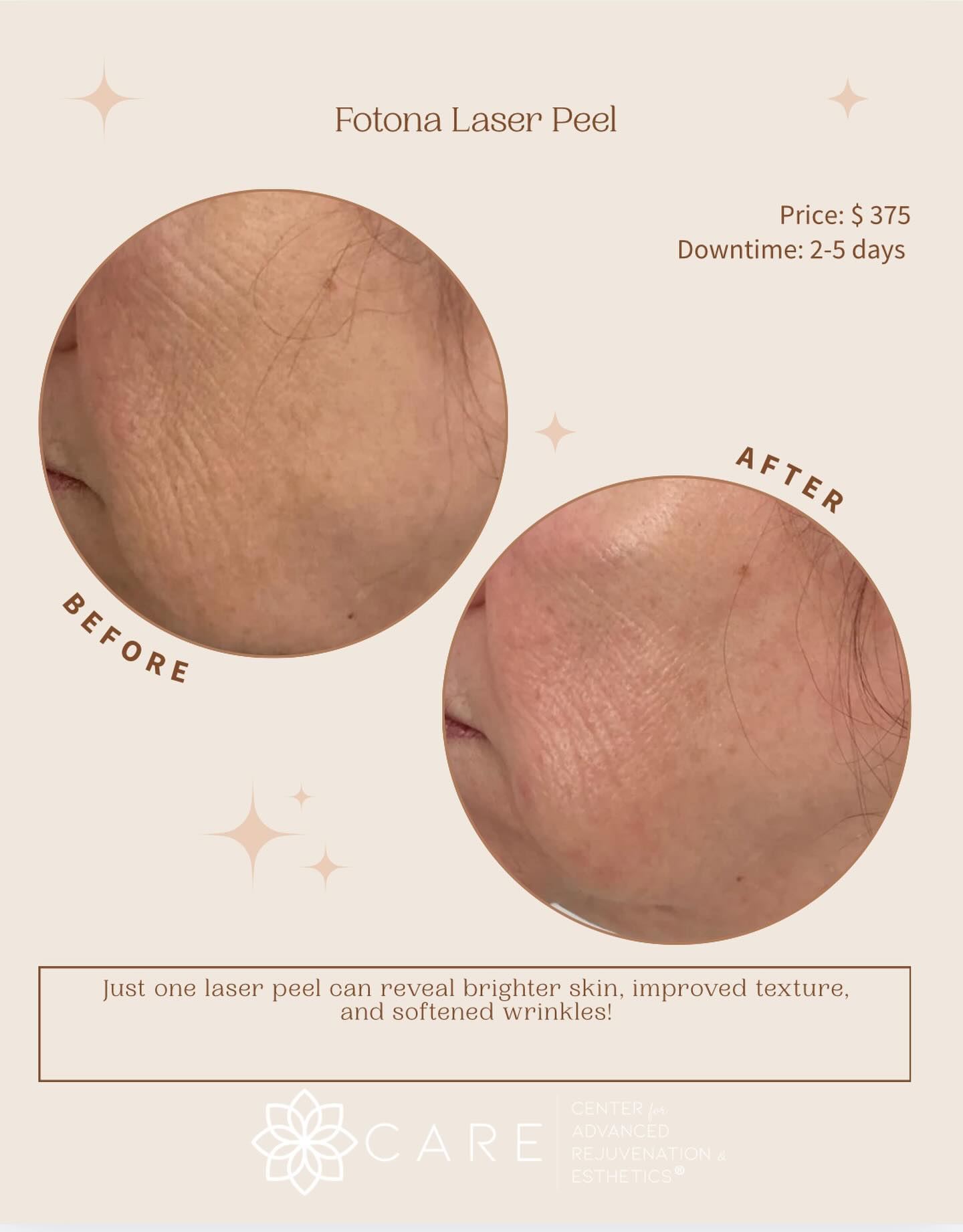✨Fotona Laser Peel ✨
We usually suggest a series of three, but just ONE treatment improves texture, reduces fine lines and brightens dull skin! Book your free consultation to learn more!