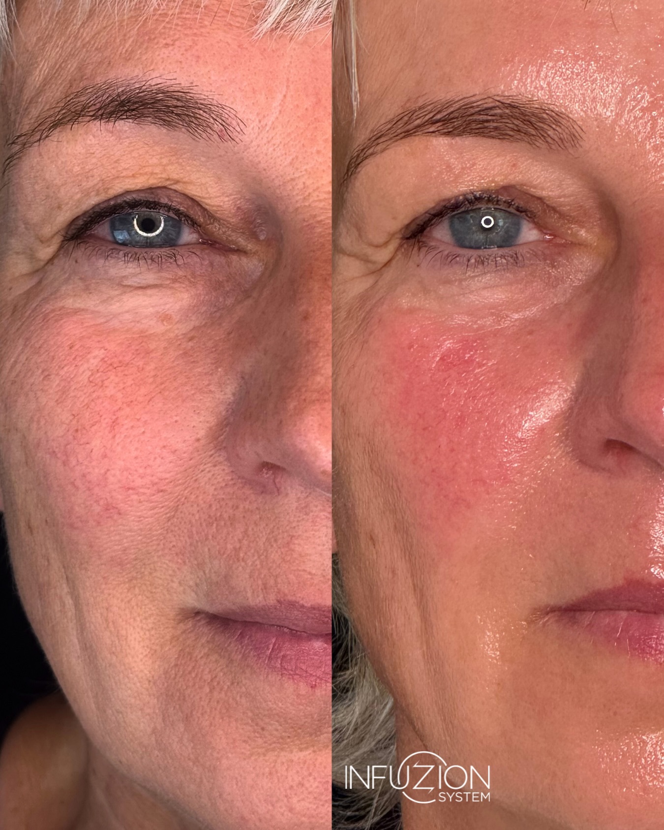 ✨Infuzion EXOZOMES✨
Ergebnis nach 2 Behandlungen im Abstand von 2 Wochen. 🤩
#exosomen #exozomes #infuzion #skinquality #nodowntime