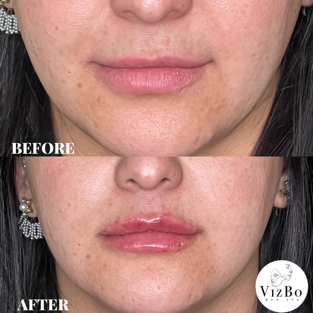 Subtle volume. Balanced shape. Natural glow.
Lip filler done right 💋
DM to book your consult
#lipfiller #medspalife #elpasolipfiller #elpasotx #elpasomedspa