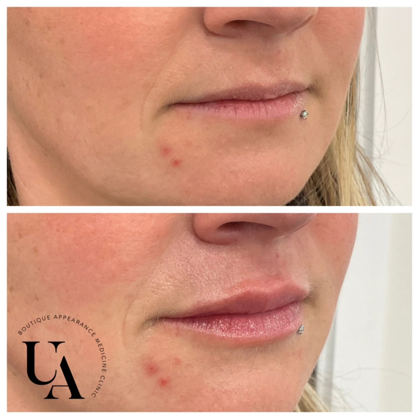 Beautiful lippies for a beautiful lady❤️❤️
#lipskapiti #lipsbyrachel #kapiticoast #lipenvy #uniqueaesthetics
Dermal filler injections are Medical devices for the treatment of loss of volume in the skin. Dermal fillers have risks and benefits. Ask your doctor if dermal filler injections are is right for you. For further information ask your doctor or go to www.medsafe.govt.nz