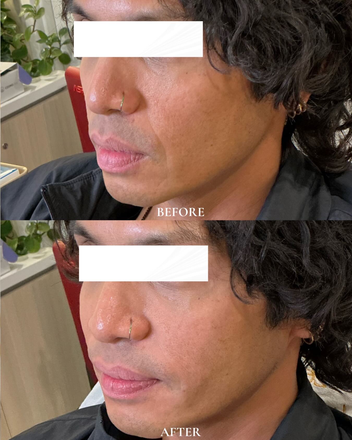 Nasolabial Fold Softening with @radiesse Biostimulator💫By RN Dillon #radiesse #injections