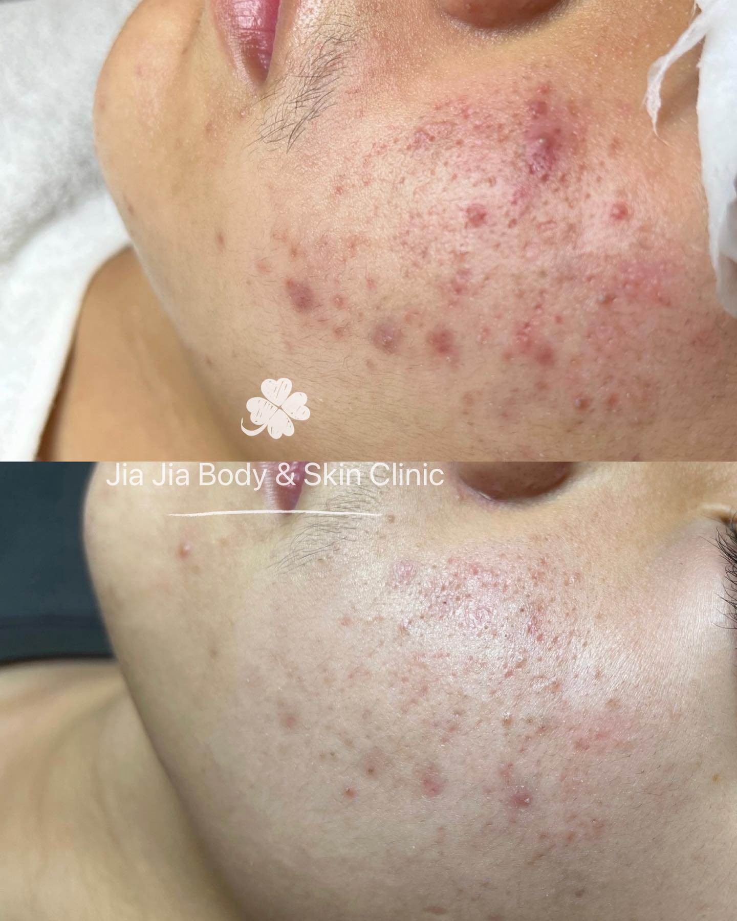 Jia Jia's Signature Acne Facial
#acnetreatment #clearskin #acne