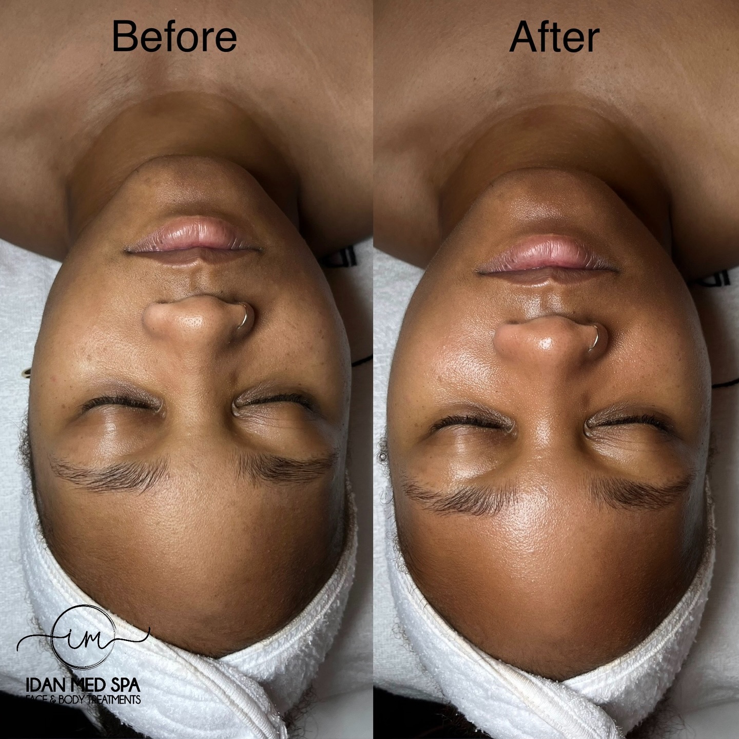 Glow like this
One session. Real results.
Hydration, extraction, and radiance, all in one Hydro Facial.
Healthy skin starts here.
Idan Med Spa | Encino & San Francisco
#LuxuryFacial #HydroGlow #HydratedSkin #EncinoAesthetics #SanFranciscoAesthetics MedSpaLife FacialTreatment SkinRejuvenation ClearSkinJourney BeautyResults CaliforniaMedSpa RFSkincare IdanMedSpa