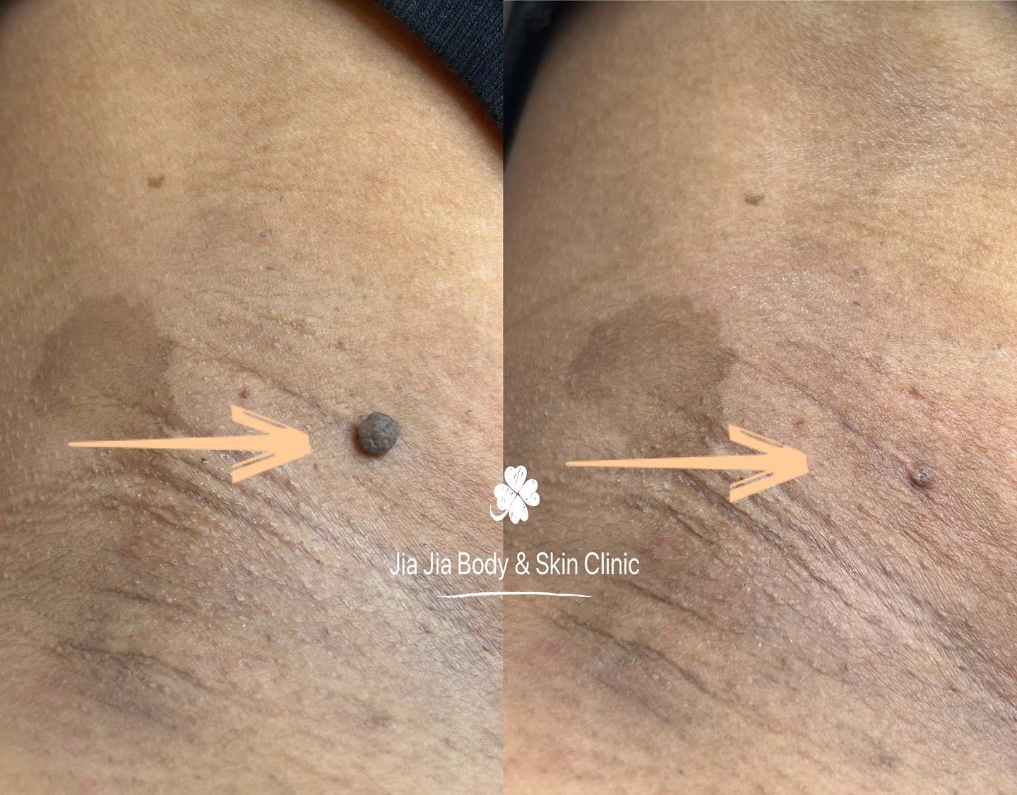 ✨ Skin Tag Removal ✨
Skin tags are small, harmless skin growths that often appear on the neck, underarms, eyelids or body due to friction or ageing.
We offer safe and quick removal with minimal discomfort and little to no downtime. Small scabs may form and heal within a few days.
💛 If skin tags bother you — we can remove them easily and safely.
📩 DM to book your appointment.