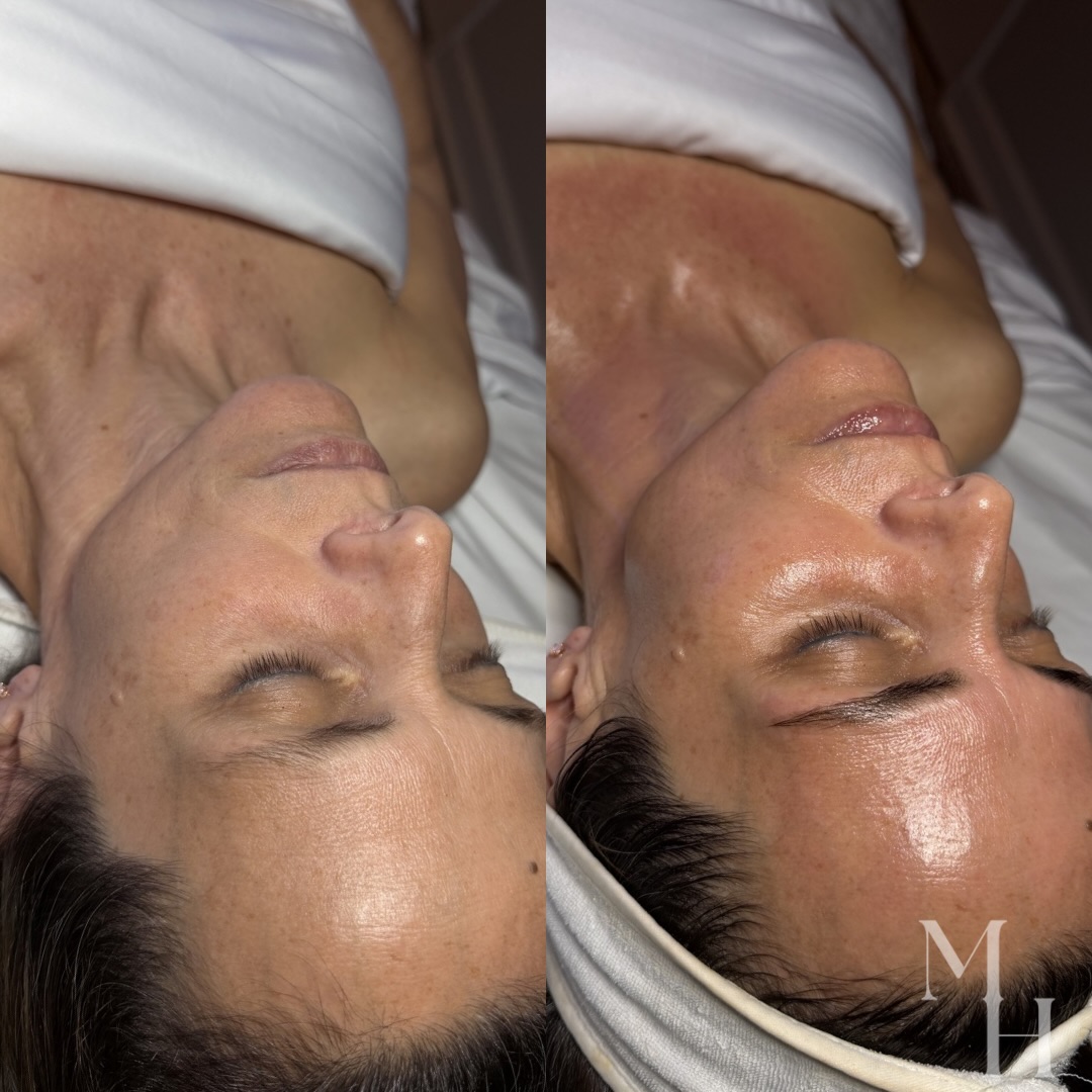 The Prestige Facial before + after 😍
We brought her glow BACK! We focused on correcting dullness, fine lines, and pigmentation.
Some inflammation seen upon her neck and chest is building collagen and wiping out sunspots. 👋🏻
So excited to see her long term transformation 🔥🔥
📍 Location:
664 Scranton Road, Suite 101
Brunswick, GA 31520
Inside Skinology Clinical Skincare
💬 Let’s Chat About Your Esthetic Goals!
📲 Call/Text: 912-223-9954
💌 DM or Facebook Messenger
🗓️ Schedule a Consultation Anytime
💻 Book Online 24/7 (link in bio)