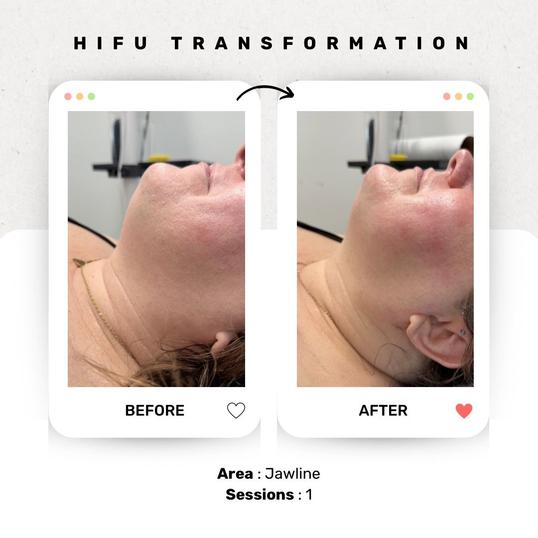 That jawline is already more defined 😍 in just one session.. we LOOOVEEE HIFU ☺️