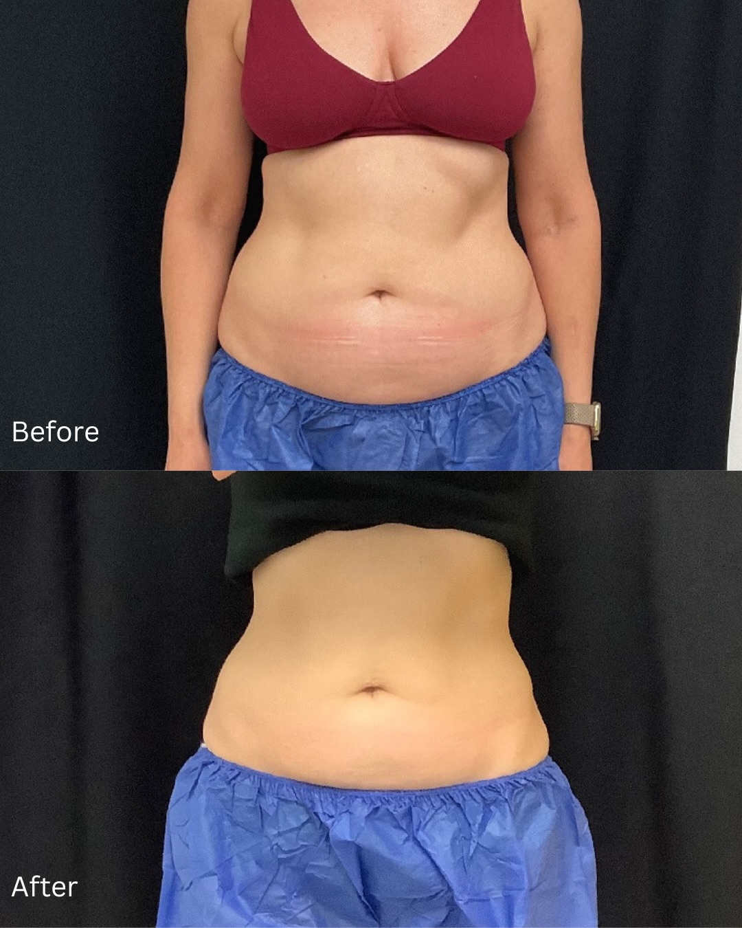 Real results 👏
If you’ve been curious about our GLP-1 program, take a look at this transformation. Interested in getting started? Check out our previous reel where our RN Elise walks you through the simple steps to begin your journey with us.
Questions? Call us or visit our website to learn more
📞- (650) 401-6060
Website linked in bio 💛