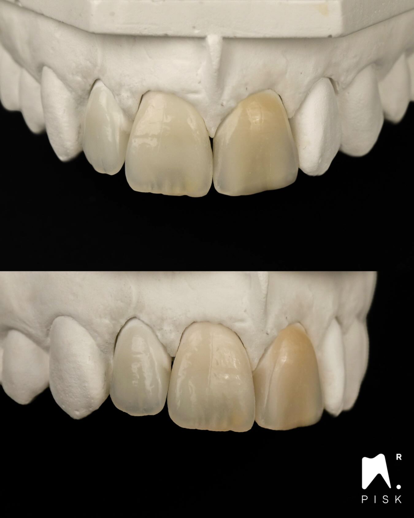Continuous learning and consistent practice are essential throughout one’s entire career. It’s important not to hesitate to train regularly on models in order to refine your techniques and improve your clinical outcomes.
Here is an example of three composite restorations performed on a plaster model using a stratification approach.
Special thanks to Thomas and Freek for their valuable advice.