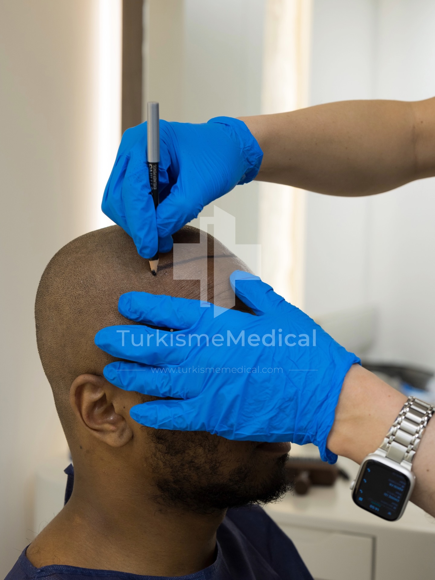 ✨Nouveau | Greffe de cheveux à Paris : intervention encadrée + suivi (J+1)
Greffe de cheveux réalisée dans une clinique partenaire a Paris avec un protocole encadré par le médecin.
Dans cette vidéo, découvrez les principales étapes : rasage, traçage, prélèvement et implantation des greffons.
Analyse capillaire gratuite sur photos.
Contact : WhatsApp / site internet.
Techniques : FUE Saphir, DHI (Choi Pen)
Localisation : Paris et Istanbul
📩 Analyse capillaire gratuite sur photos
📍 Paris (France)
🧑🏻⚕️Plan de greffe validé par le médecin le jour de l’intervention
✅ Suivi : contrôle + premier lavage (J+1)
#greffedecheveux #greffecapillaire #paris