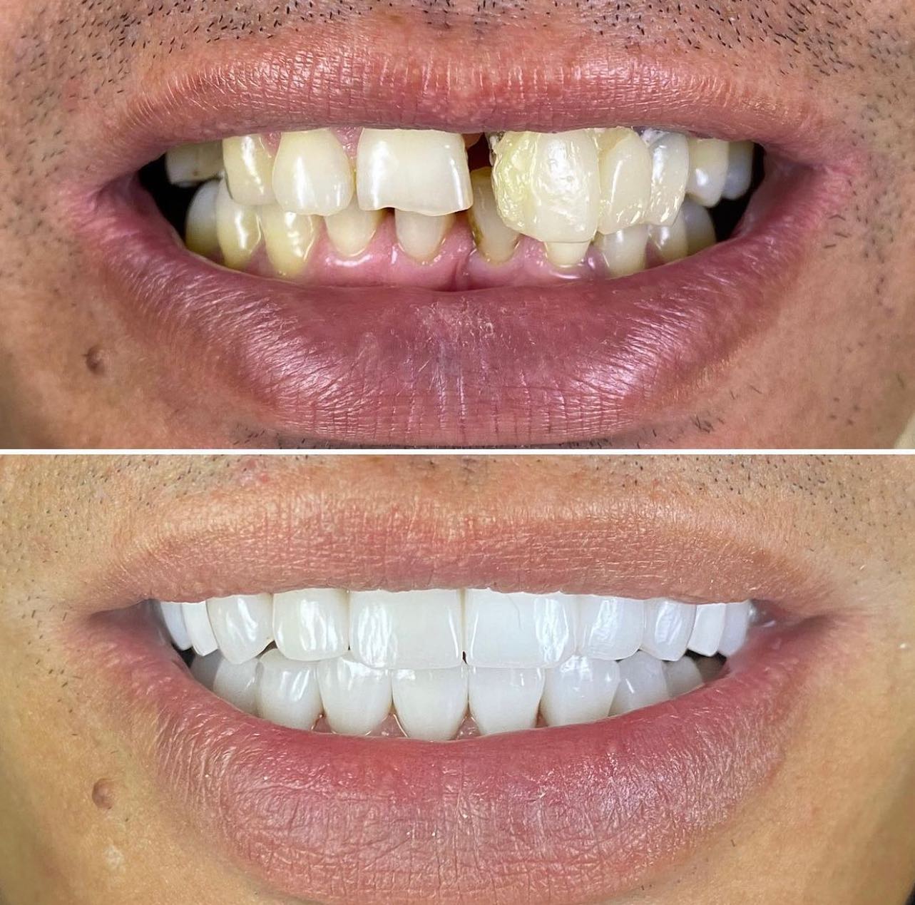20 EMAX Crowns Before/After of one of our many patient from all over the world.
-
https://www.veneers.istanbul
-
WhatsApp: 00905330164562
-
#veneers #smiledesign #cosmeticdentistry #restorativedentistry #emax #veneer #laminates #zirconia #zirconium #hollywoodsmile #dentalcrowns #crowns #veneersistanbul #porcelainveneers #emaxveneers