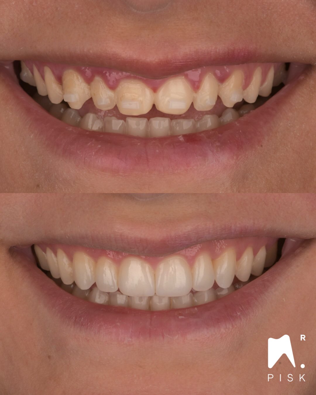 Simple layering & injection : ONLY WITH INJECTABLE COMPOSITE !
You want to learn simple layering and injection ? DM to book a course : website « formation dentaire HDF »
PS : and a bit of gingivectomy for the better zenith position