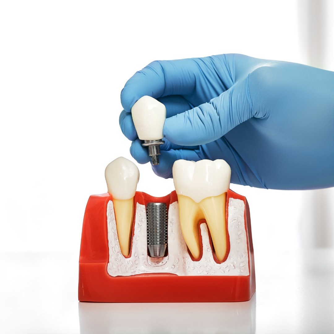 FAQ: What are dental implants❓
Dental implants 🦷 are a permanent solution for missing teeth that consist of 3 parts:
▶️ Implant: A titanium post or screw is inserted into the jaw bone.
▶️ Abutment: This connector links the dental implant to the crown.
▶️ Crown: An artificial tooth made of porcelain or zirconia, designed to match natural teeth.
Implants offer a comprehensive and lasting dental solution to missing teeth! Have more questions, we are happy to help!