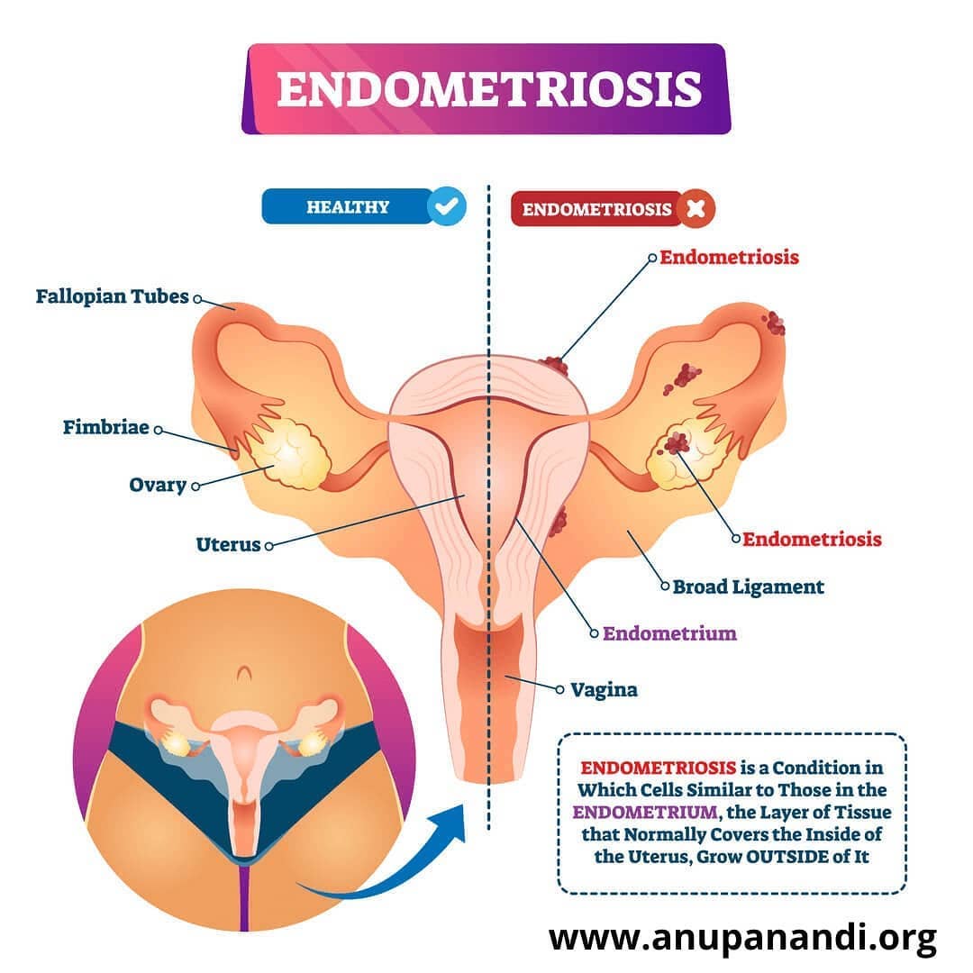 Endometriosis is a common condition and is associated with infertility.
Surgical treatment can improve chances of pregnancy in mild endometriosis.
While IUI can be done for mild endometriosis with normal tubes, IVF should be done for severe endometriosis, those with blocked tubes, those trying for long duration >3 years or in women with advanced age.
Majority of women with endometriosis will have a normal pregnancy.
Watch the video in youtube: Dr Anupa Nandi
.
.
.
#endometriosis #endometriosiswarrior #endometriosisawareness #endometriosispain #endometrioma #infertility #infertilityawareness #infertilitysucks #fertility #pregnancy #pain