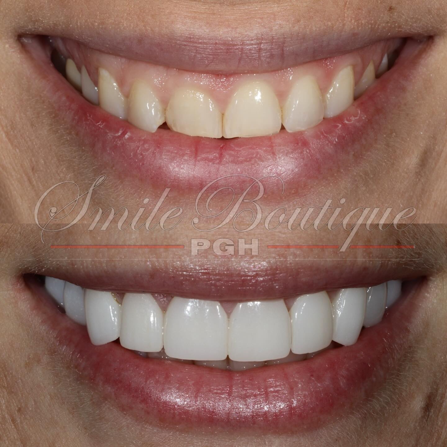 Monday Motivation 🤩
Featuring Dr. @k.ziggas’ smile transformation 🙌
Her dislikes (✖️) & what we achieved (✔️):
✖️ Small teeth (don’t show enough when she smiles)
✖️ Crooked teeth (tooth sticking out)
✖️ Uneven size teeth
✖️ Stained teeth
✖️ Crooked teeth
✖️ Gummy smile
✖️ Chipped & cracked teeth (teeth wearing away)
✔️ Balanced Smile
✔️ Brighter smile
✔️ Straighter teeth
✔️ Fuller smile
✔️ Showing more teeth when smiling
✔️ Reduced gummy show
✔️ Created symmetry
✔️ Strengthened teeth
✔️ Created appropriate teeth size & dimensions
Procedure prescribed:
1️⃣ Top - 10 units of Lithium Disilicate veneers
Honored and privileged to have another medical professional entrusted her smile transformation with me 🙏
End result = another happy confident smiling patient 🤩
Want your dream smile, schedule your consult with link in bio.
#winning #mondayvibes #mondaymotivation #PittsburghSmiles #smiletransformation