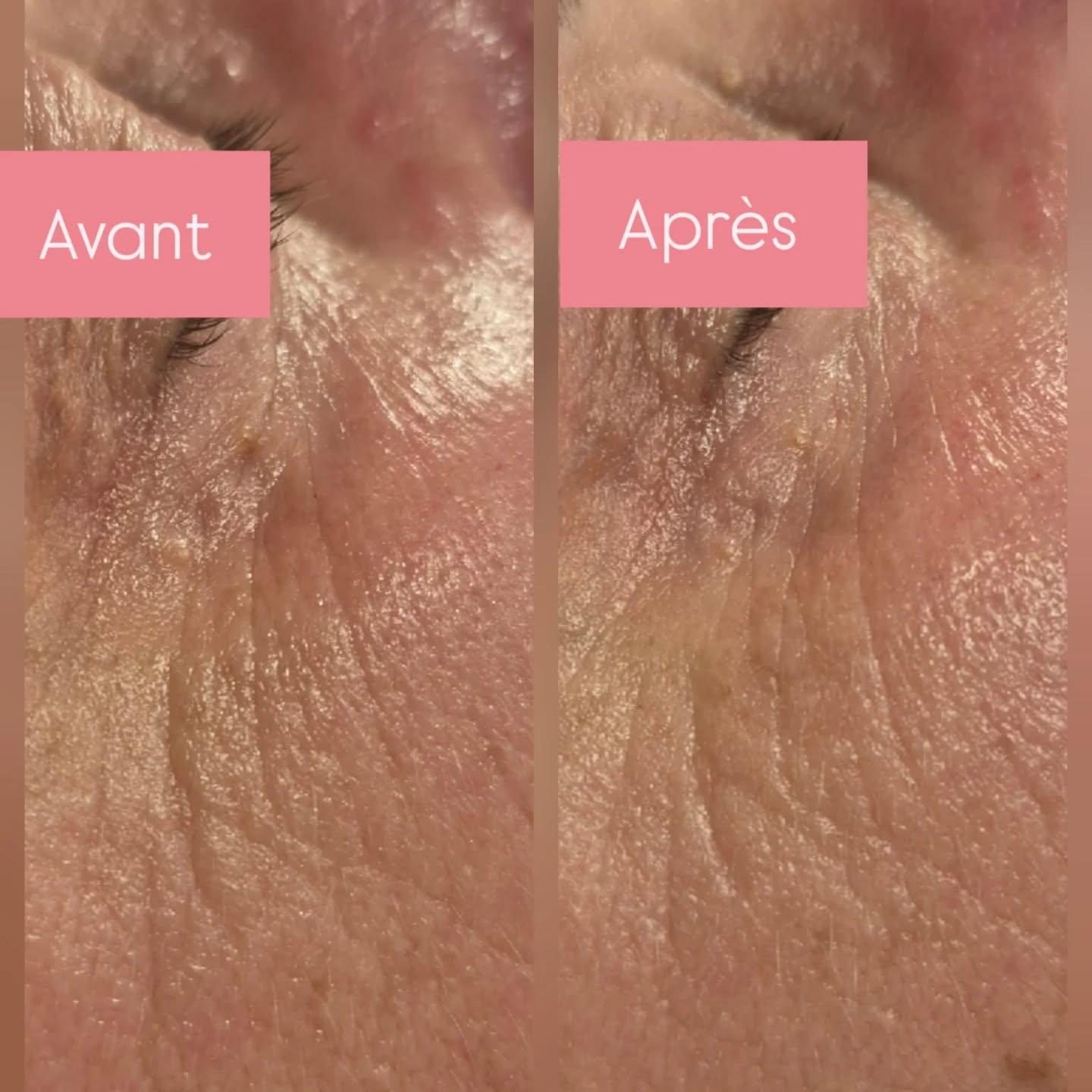 Résultat après un seul soin beauté du regard
Rides moins profondes, peau plus lumineuse, poches réduites grâce aux manœuvres drainantes...
Possibilité de plus de résultats avec une cure de 5 soins + 1 offert .🙌