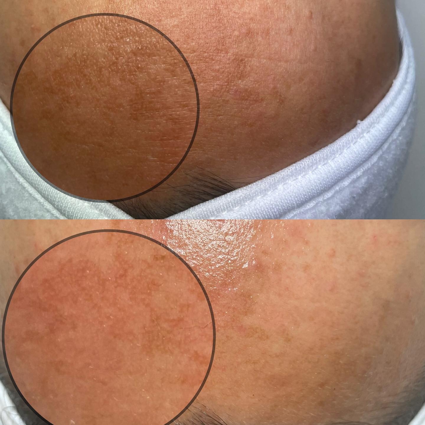 Melasma is no joke and definitely hard to treat but it’s not impossible.
Used @circadia zymase enzyme, oxygen treatment, Australian antioxidant brightening mask
Used @herbalskinsolutions Mandelic peel 3 layers with nano infusion
Overall heathy glowing skin and chipping away at that melasma one facial at a time 😍😍😍
#BrighteningFacial#NanoInfusion#Melasma#OrangeCountyEsthetician#OrangeCountyFacials#FacialResults#Circadiafacial#HerbalSkinSolutions