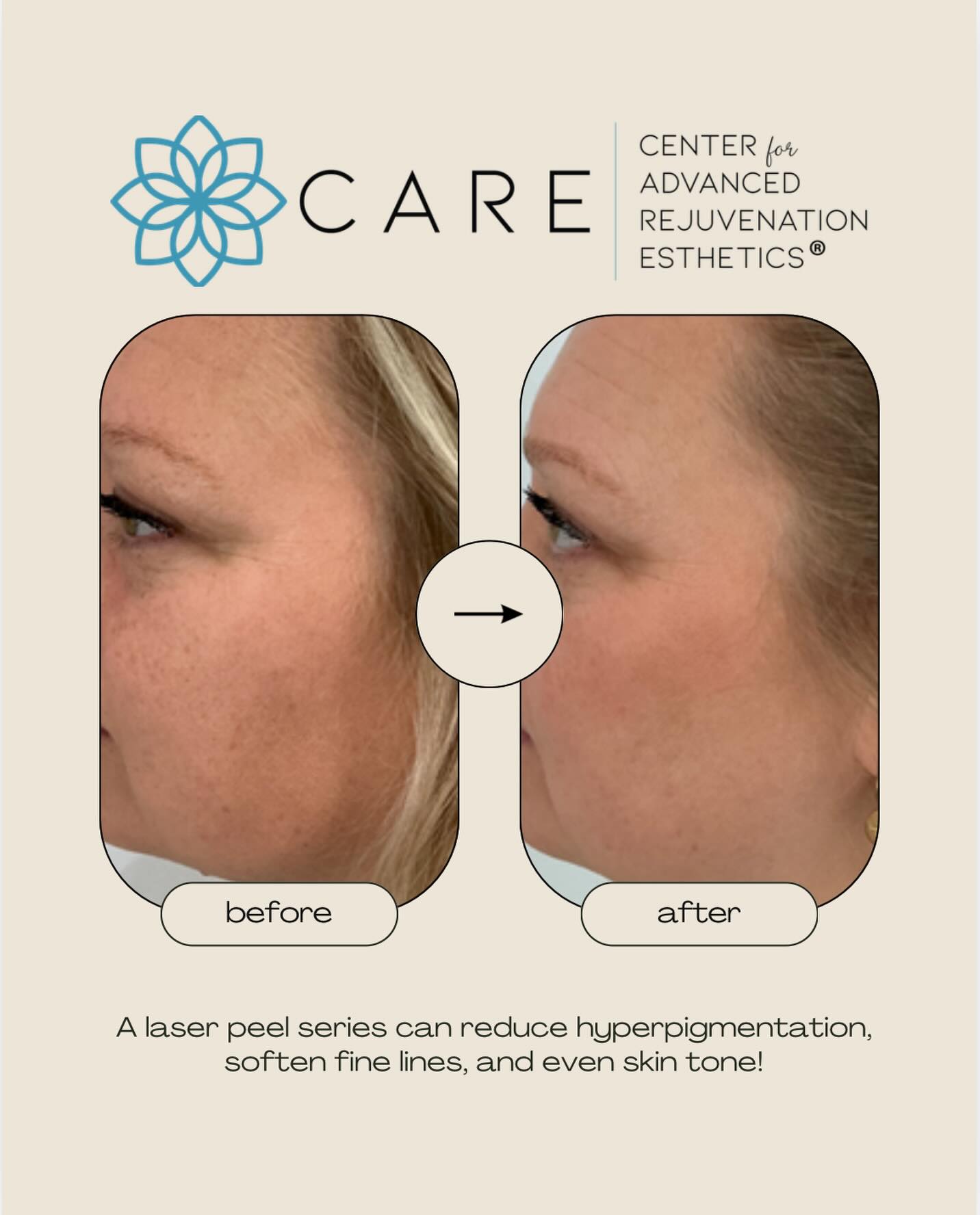 A laser peel series can help reduce hyperpigmentation, soften fine lines, and create a more even skin tone. This transformation shows how powerful consistent treatments can be. If you are ready to refresh your skin, CARE is here to help!