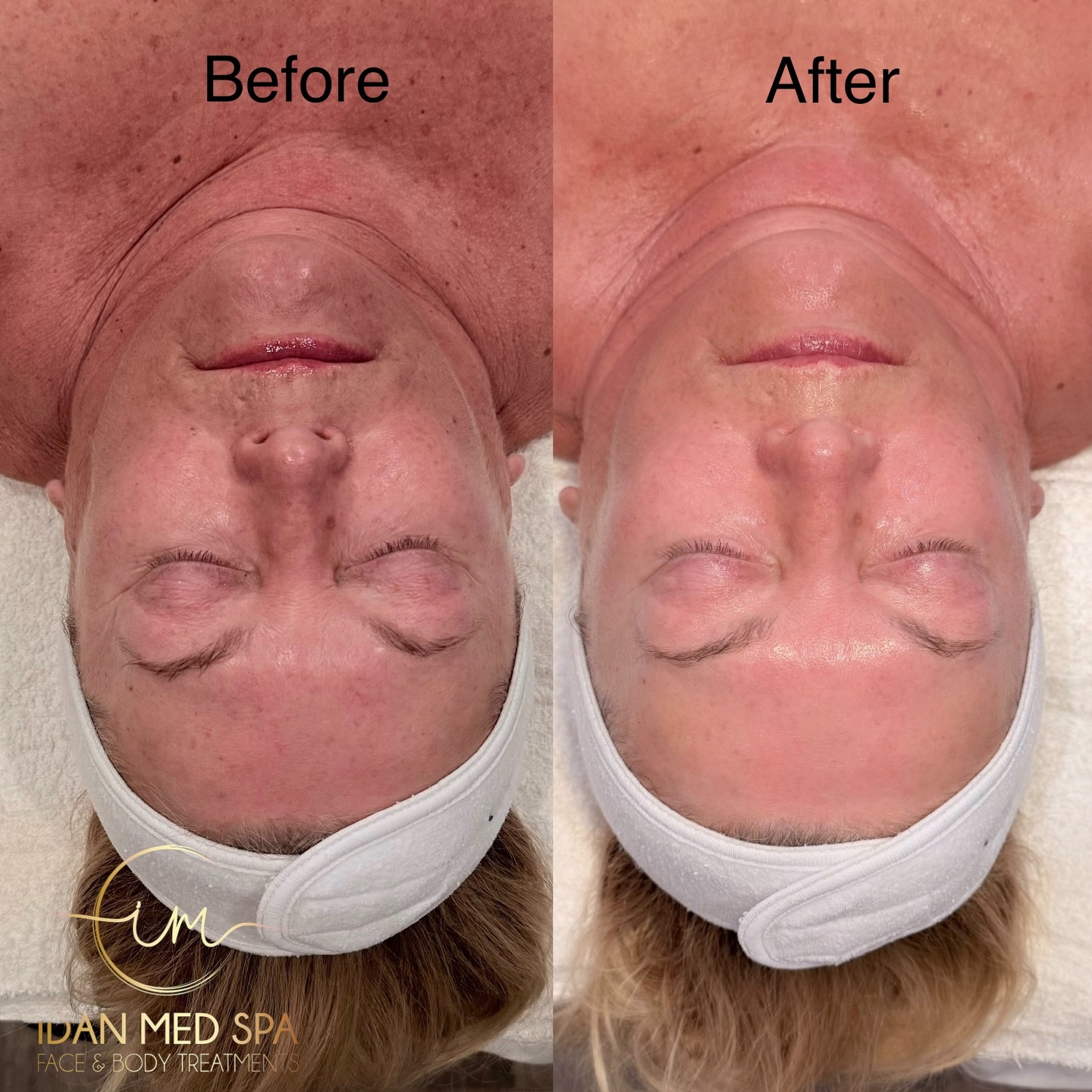 Resurface Renewal Facial Results
Look at this amazing transformation! These results are after 4 Resurface Renewal Facial treatments, showing smoother texture, clearer pores, and brighter, healthier-looking skin.
Our Resurface Renewal Facial helps remove dead skin cells, improve skin texture, and boost natural skin renewal for long-term results.
Perfect for:
✔️ Dull skin
✔️ Uneven texture
✔️ Congested pores
✔️ Fine lines
✔️ Acne marks
Consistent treatments = real skin transformation. Your best skin takes time, and the results speak for themselves!
📍 Book your appointment today and start your skin renewal journey.
#ResurfaceRenewal #BeforeAndAfterSkin #SkinResurfacing #MedSpaResults #GlowingSkin HealthySkin FacialTreatment MedicalGradeSkincare SkinTransformation EstheticianLife MedSpa SkinCareResults AcneTreatment SkinImprove