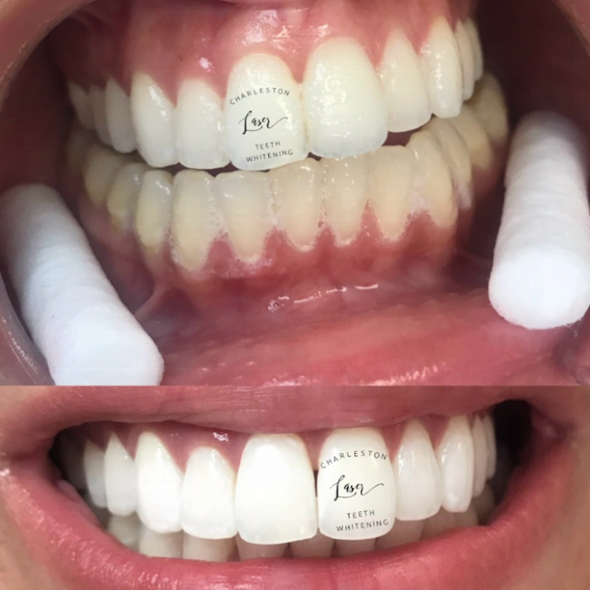 Charleston rule: if you’re running the bridge, your smile better shine in the finish line photos 🏁✨😁🥇
Book your teeth whitening now!
www.CharlestonLaserTeethWhitening.com
teethwhitening charlestonteethwhitening charleston charlestonsc charlestonlaserteethwhitening mountpleasant mountpleasantsc kiawahisland kiawahjamesisland westashley isleofpalms downtowncharleston sullivansisland johnsisland johnsisland northcharleston northcharlestonsc folly follybeach