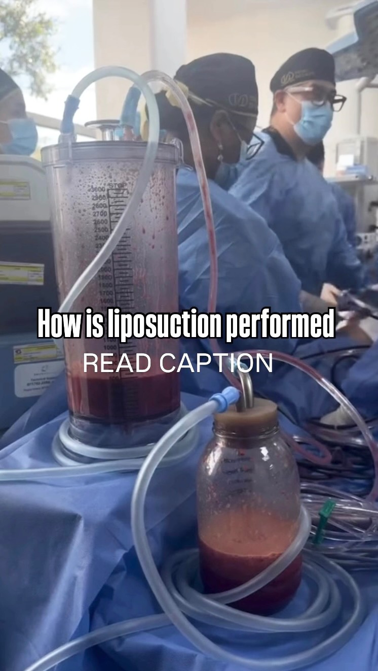 𝐈𝐧𝐬𝐢𝐝𝐞 𝐭𝐡𝐞 𝐎𝐑 🏥 @alfredohoyosmd @totaldefiner
There’s a big difference between performing post-operative care… and truly understanding surgery.
Being inside the operating room and witnessing liposuction being performed is a powerful reminder of what the body actually goes through during these procedures.
During liposuction, a small cannula is inserted beneath the skin to break up and suction fat cells, creating controlled tunnels within the fat layer. While surgeons sculpt the body, the procedure also impacts:
• the lymphatic system
• connective tissue and fascia
• inflammation and fluid balance
Which is why recovery isn’t just about massage — it’s about supporting the body through a very real healing process.
At Trust Surgery Consultants, our protocols are designed with surgical understanding in mind, combining:
✨ Manual Lymphatic Drainage
✨ Fibrosis prevention techniques
✨ Advanced technologies like Tecar & Aspen Therapy
✨ Surgeon-aligned recovery protocols
Because when you understand what happens inside the OR, you can protect the results outside of it.
#PostOpCare #PlasticSurgeryRecovery #Liposuction #TotalDefiner #FibrosisPrevention